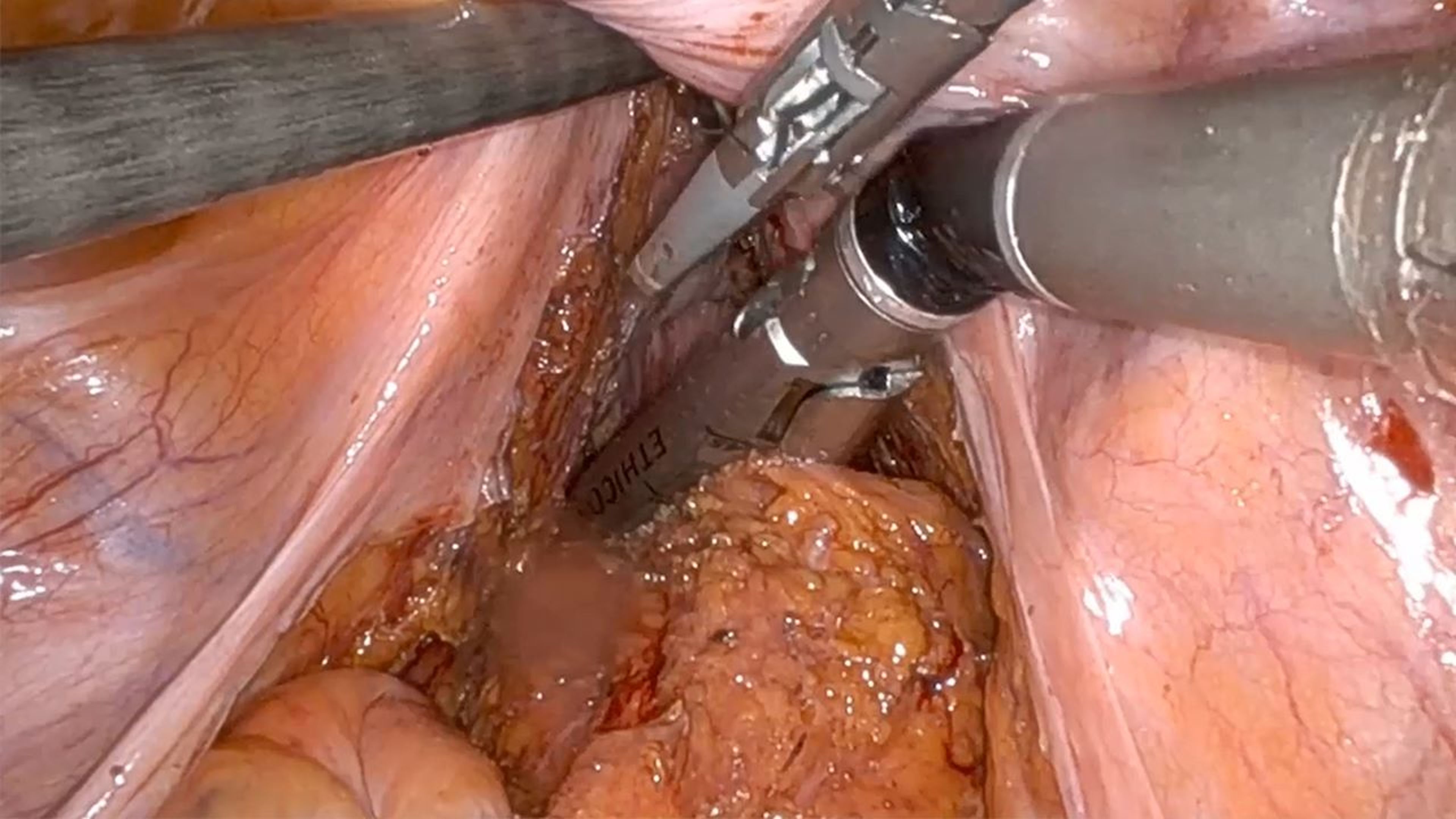US_SRG_STAP_117755.1 - Low anterior resection using the ECHELON™ 3000 Stapler with Diego Marines, MD