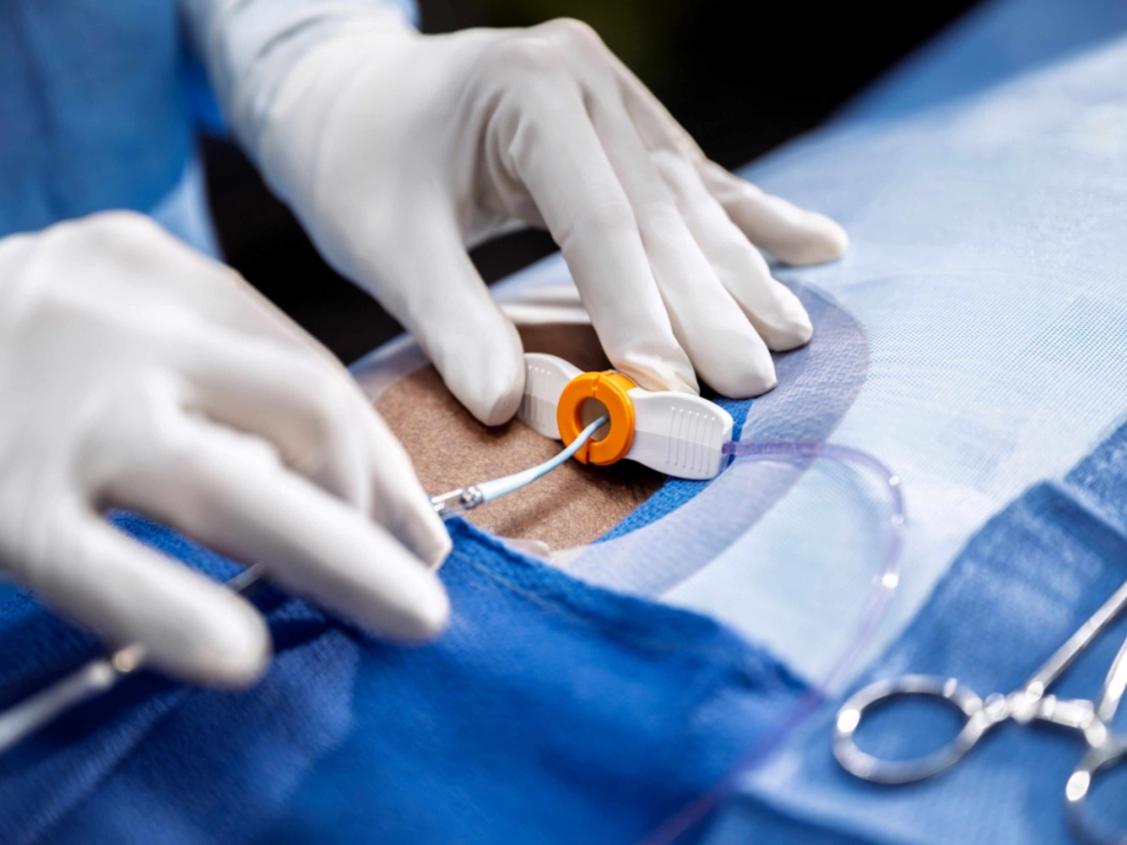 Close-up view of an endovascular procedure showing the sheath inserted in the groin and the inlet portion of the Impella catheter being positioned by a clinician wearing sterile gloves.
