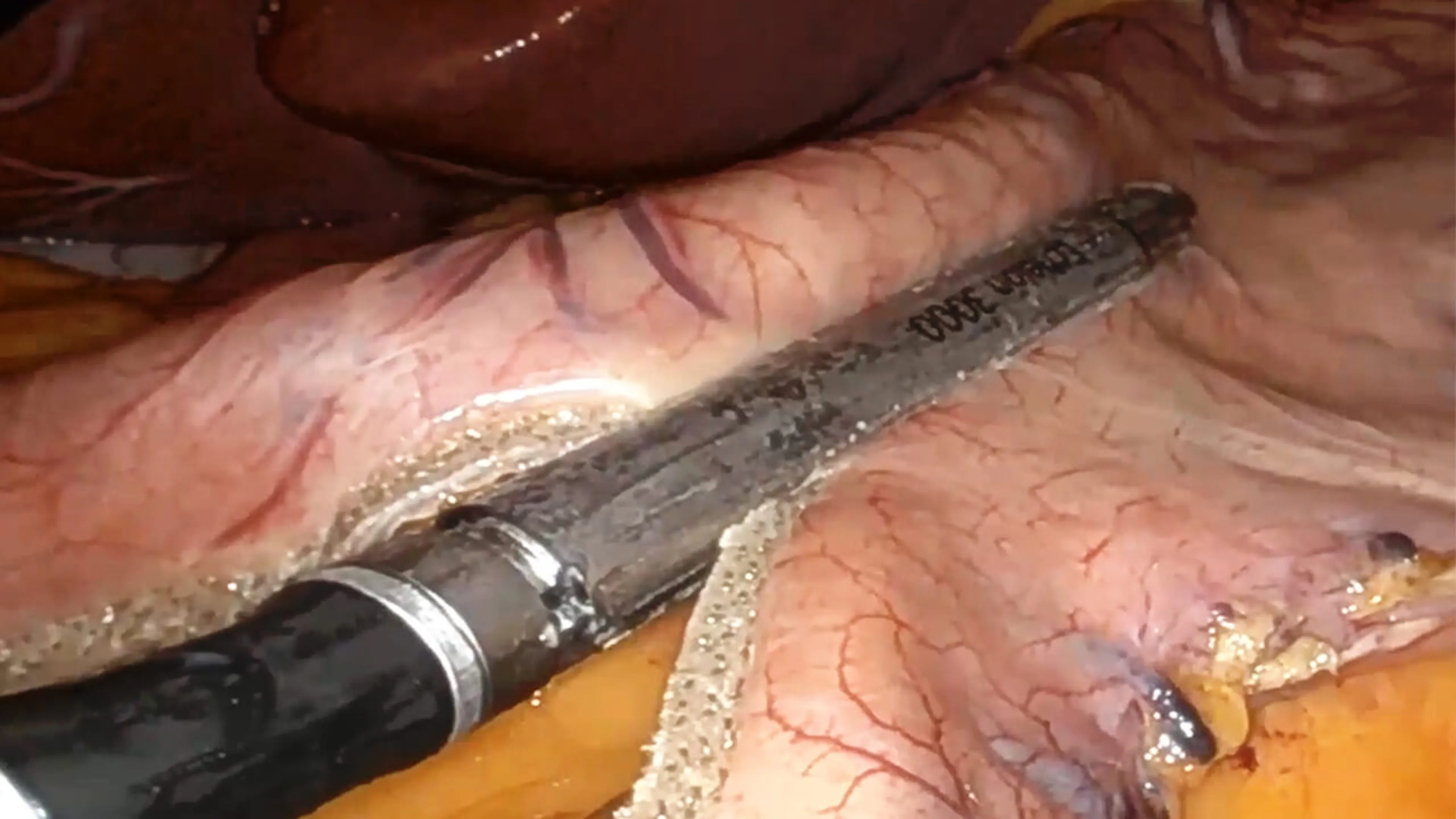 US_ETH_STAP_218518 - Robotic sleeve gastrectomy using the ECHELON™ 3000 Stapler with ECHELON ENDOPATH™ Staple Line Reinforcement with Brian Binetti, MD