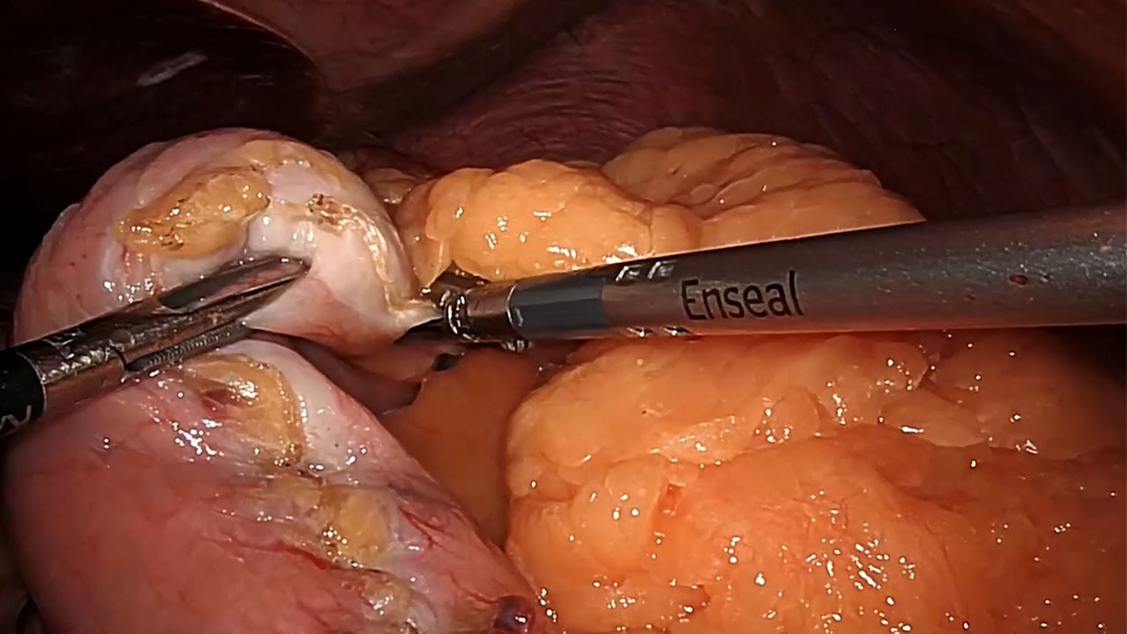US_ETH_STAP_117801 - Laparoscopic sleeve gastrectomy using the ENSEAL™ X1 Straight Jaw Tissue Sealer and ECHELON™ 3000 Stapler with Kelvin Higa, MD