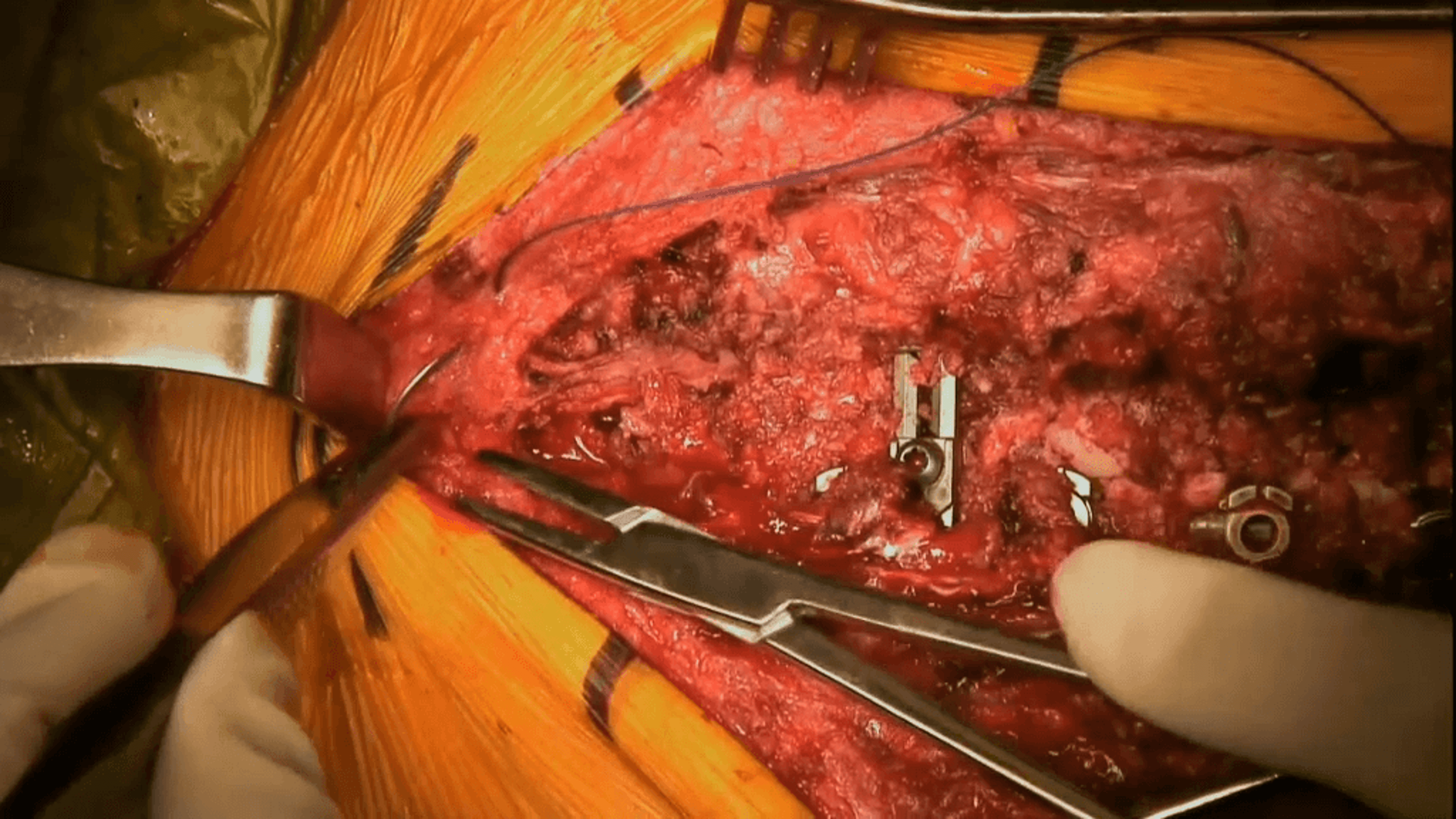 US_ETH_WOUN_111254.1 - Posterior spinal fusion for adolescent idiopathic scoliosis using STRATAFIX™ Symmetric  PDS™ Plus Knotless Tissue  Control Device with Amer Samdani, MD