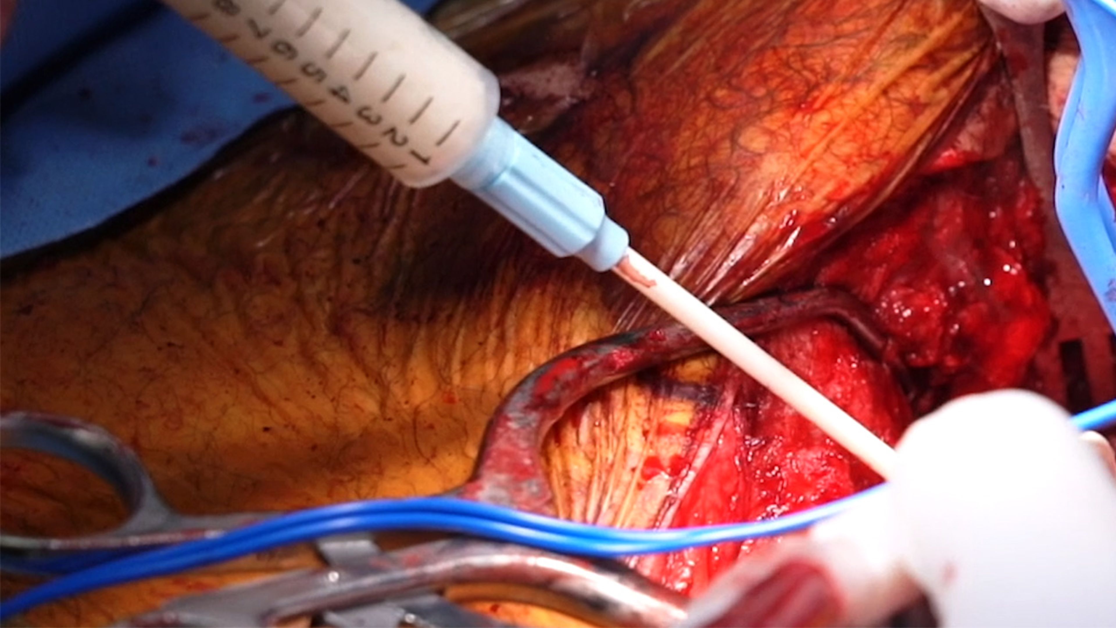 US_ETH_BIOS_129910 - Spine revision surgery using SURGIFLO™ Hemostatic Matrix Kit with Michael Wang, MD