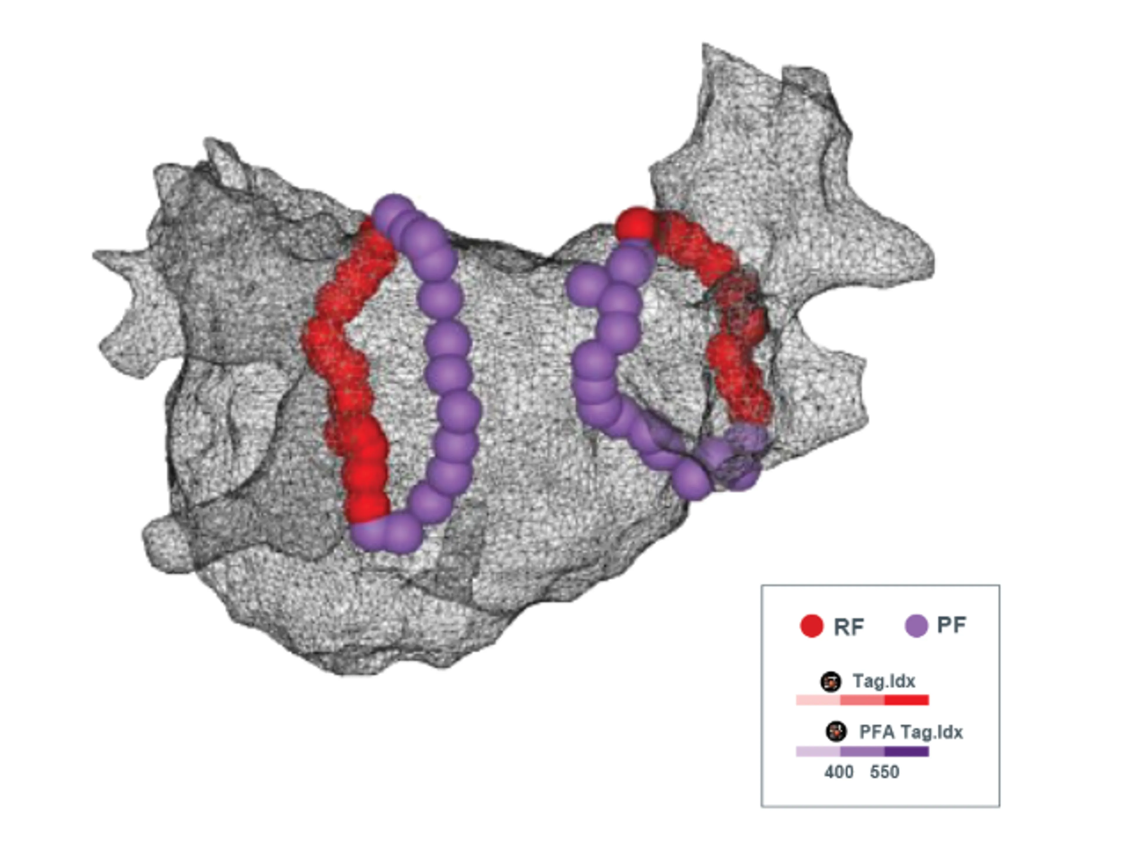 Post-ablation map using Dual Energy THERMOCOOL SMARTTOUCH™ SF Platform