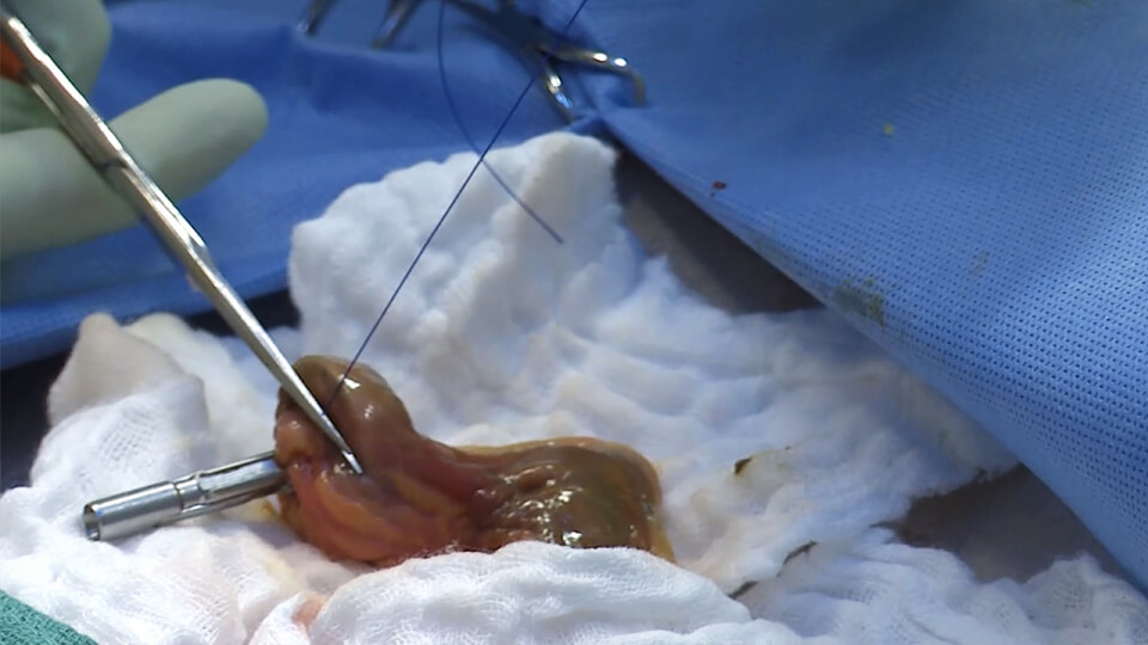 Laparoscopic Left Colectomy and Low Anterior Resection in a Cadaver Model with David Longcope, MD