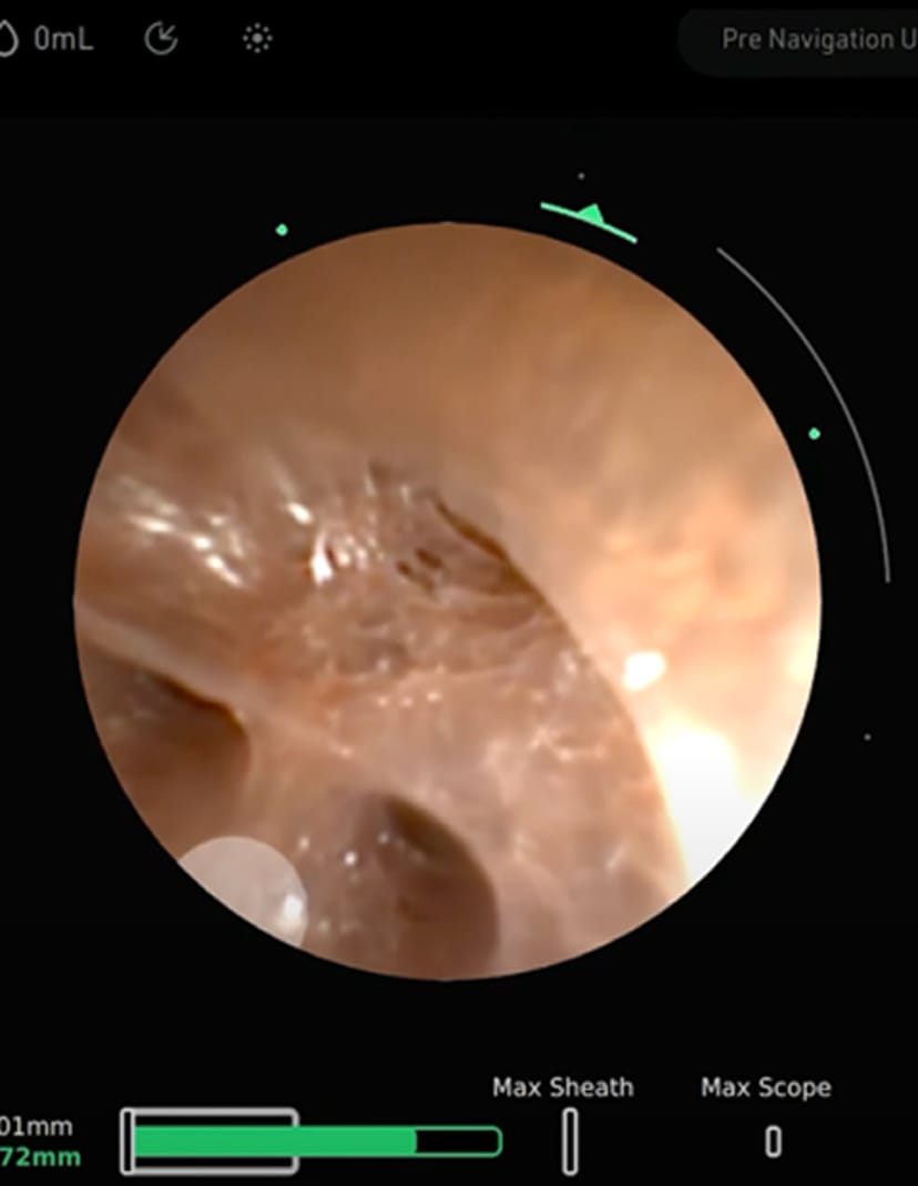 MONARCH Platform | Robotic-assisted bronchoscopy (RAB) | J&J MedTech US