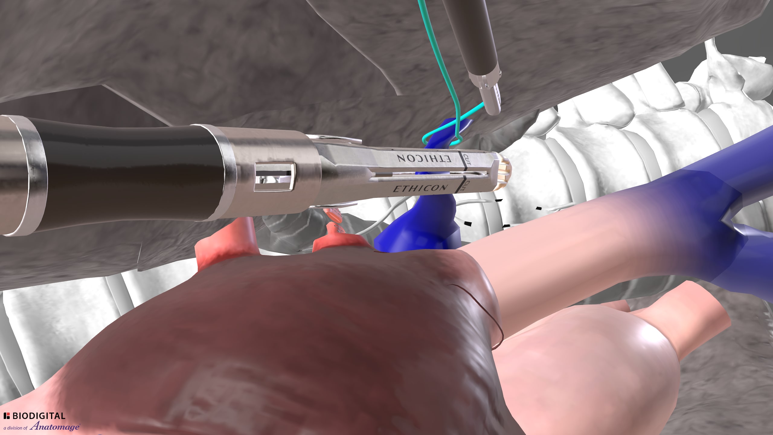Thoracoscopic lobectomy