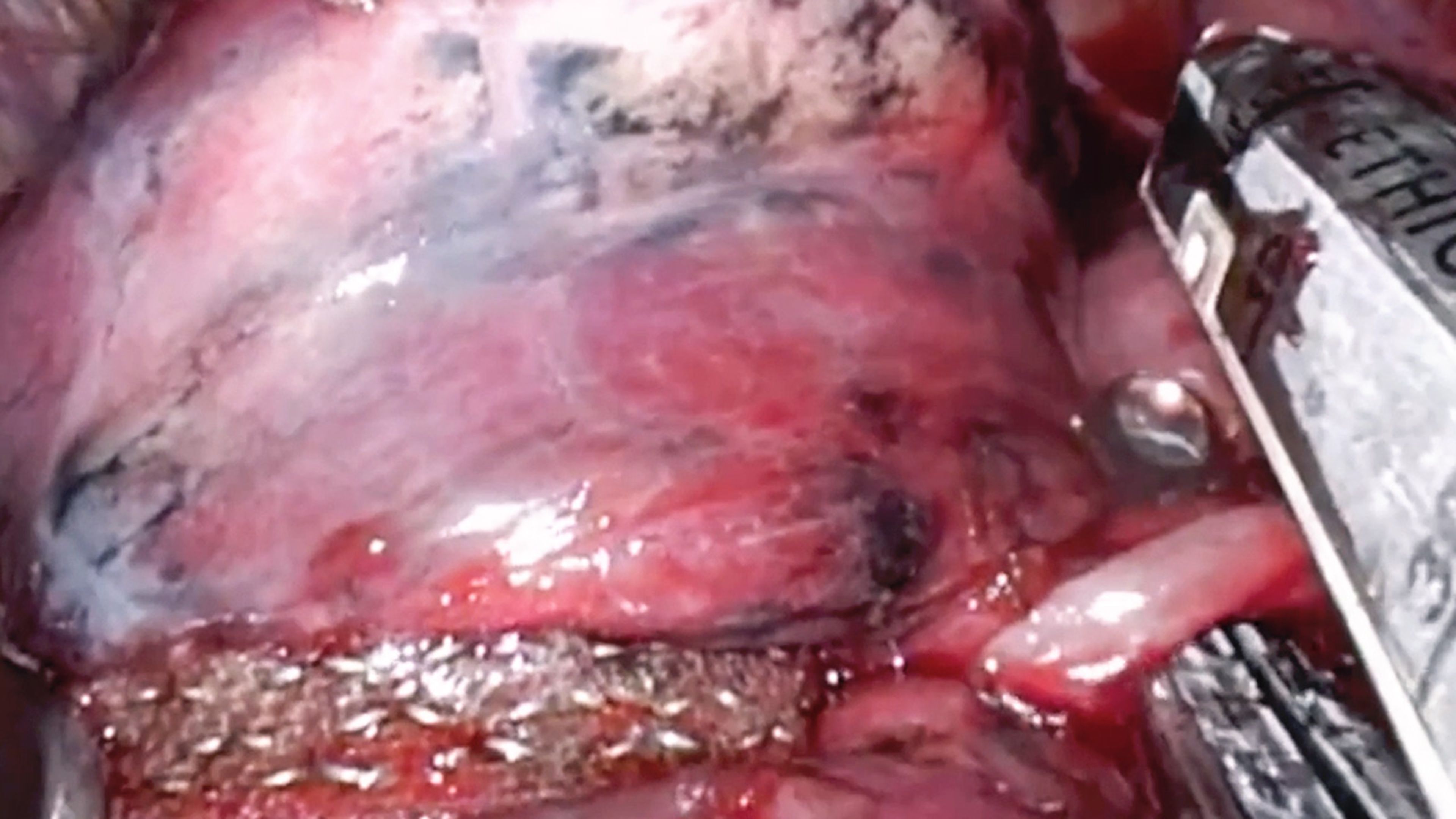 US_ETH_STAP_390578 - Uniportal VATS left upper lobectomy using the ECHELON FLEX™ Powered Vascular Stapler and ECHELON™+ Stapler with staple line reinforcement with David Zeltsman, MD