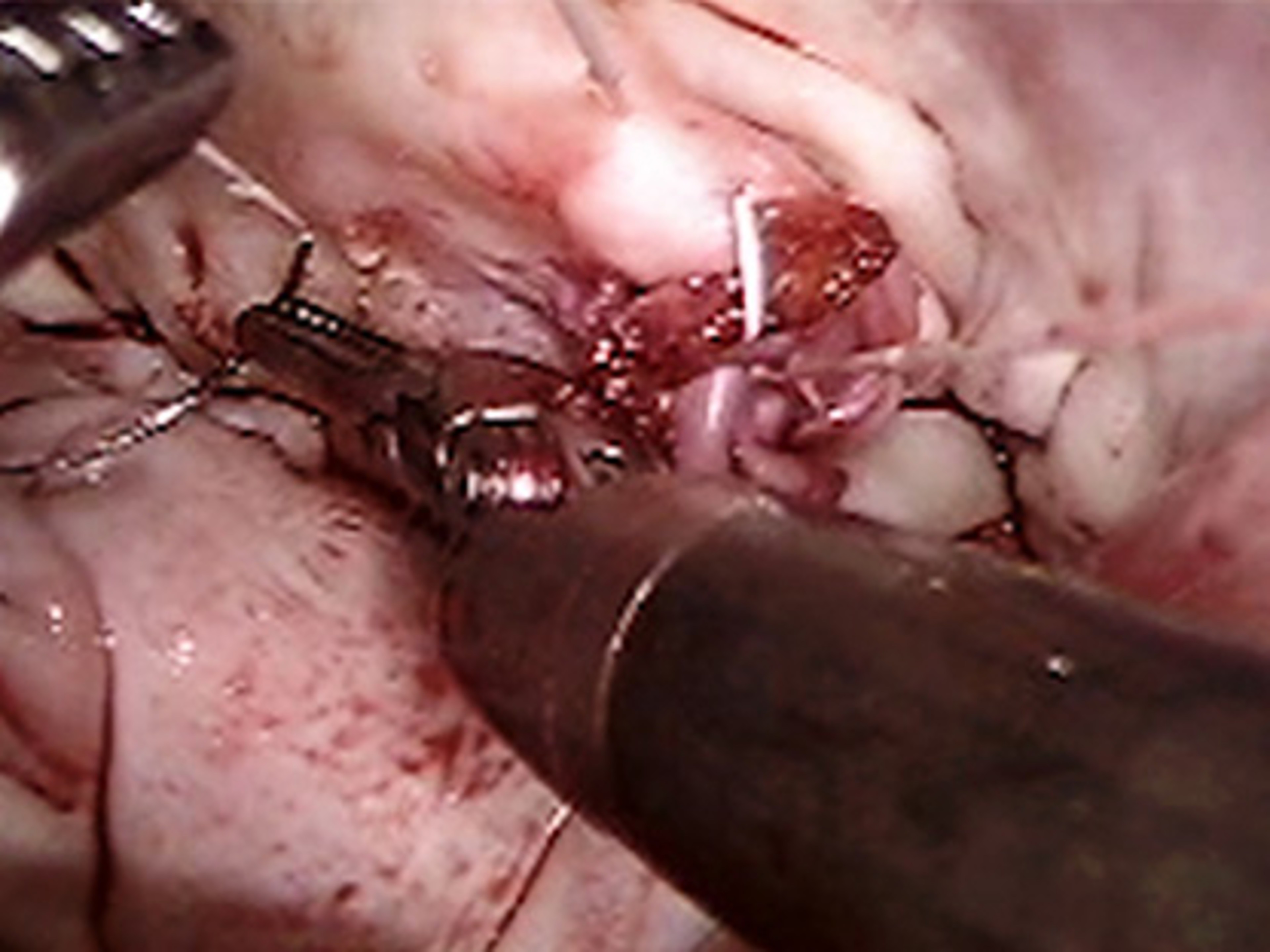 Mitral valve repair with Bob Kiaii, MD