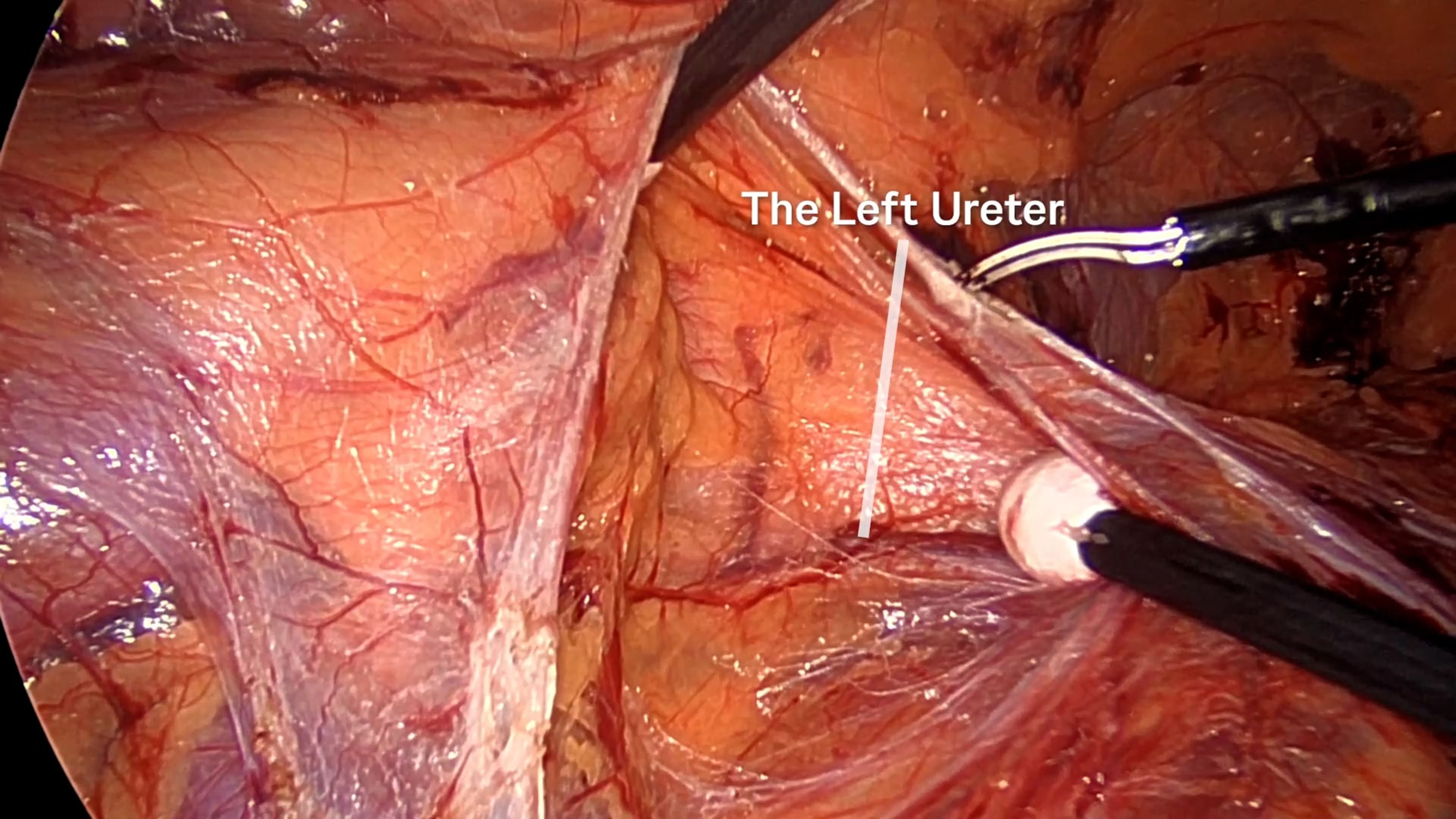 ureter is identified