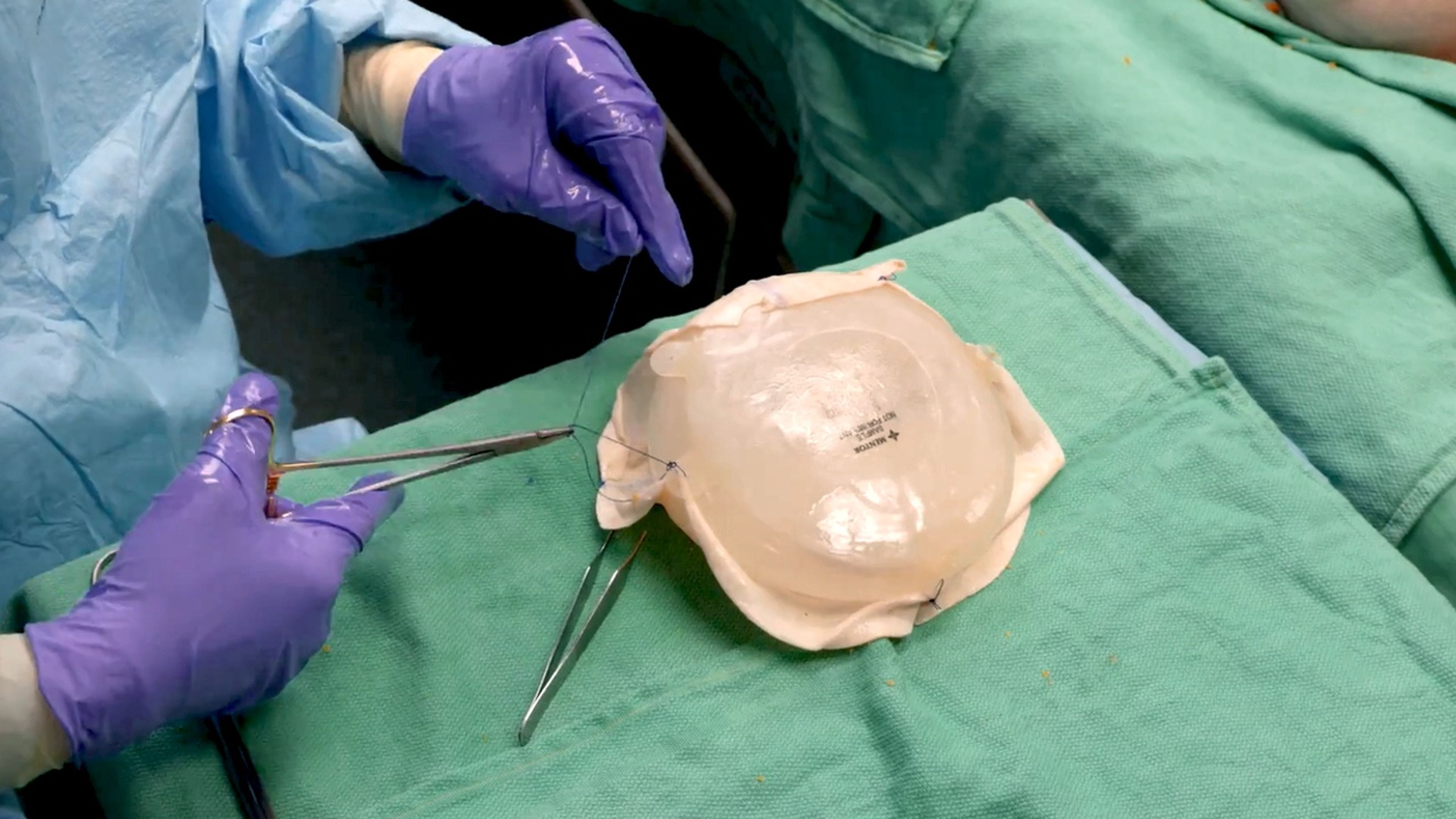 US_MNT_BRST_399827 - Prepectoral breast reconstruction using MENTOR™ MemoryGel™ Enhance Implants with Risal Djohan, MD