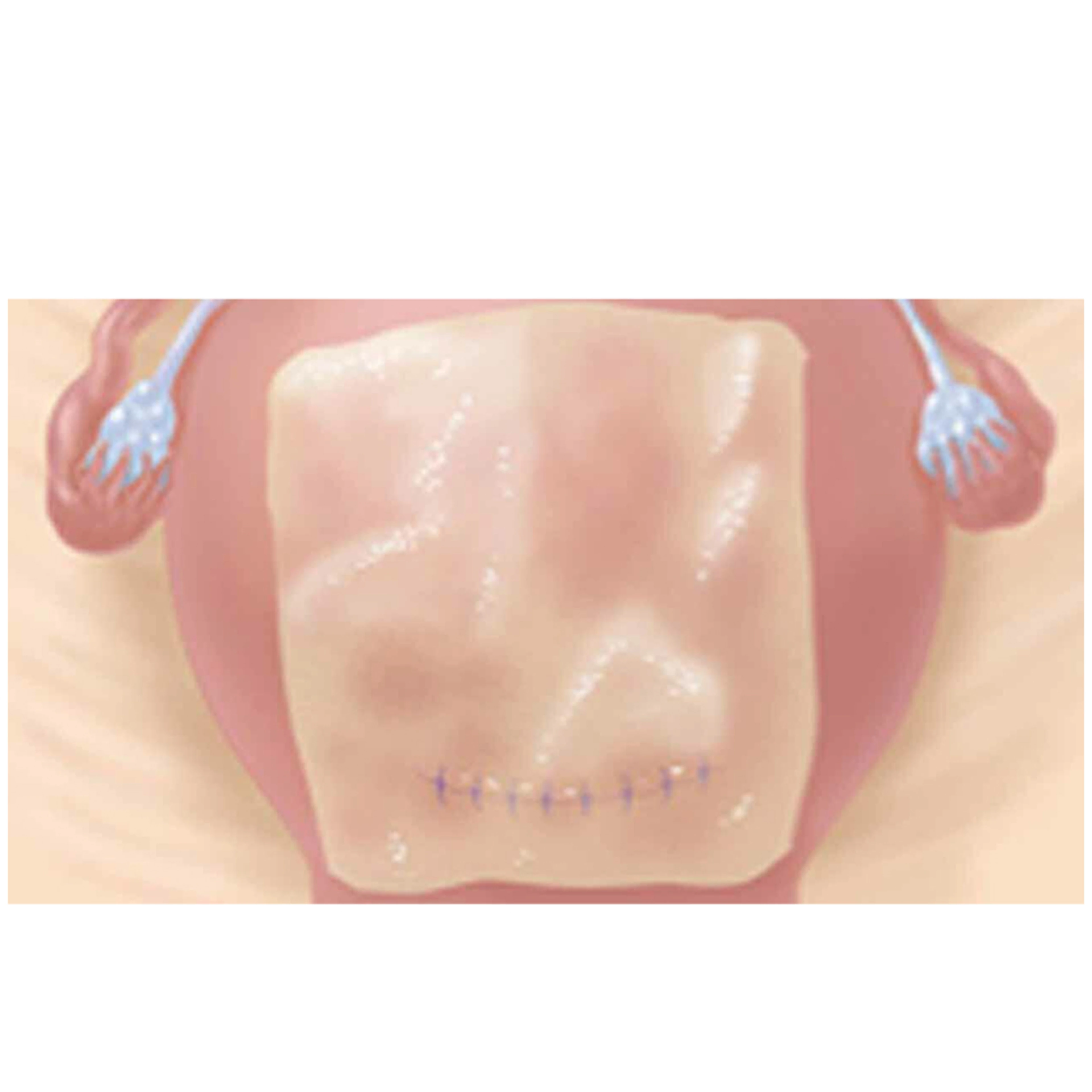 GYNECARE INTERCEED Absorbable Adhesion Barrier installed on a patient