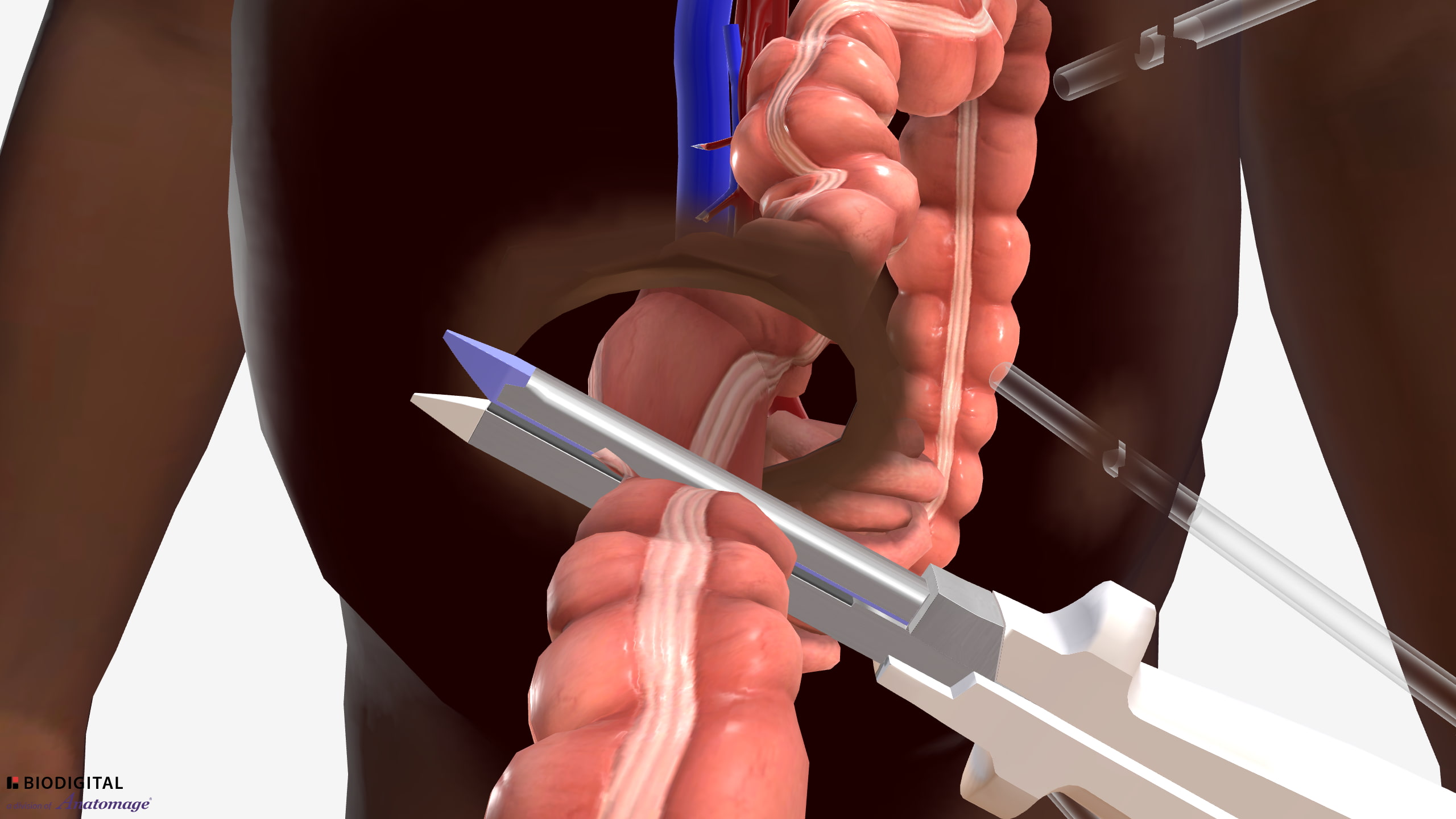 Laparoscopic Right Hemicolectomy