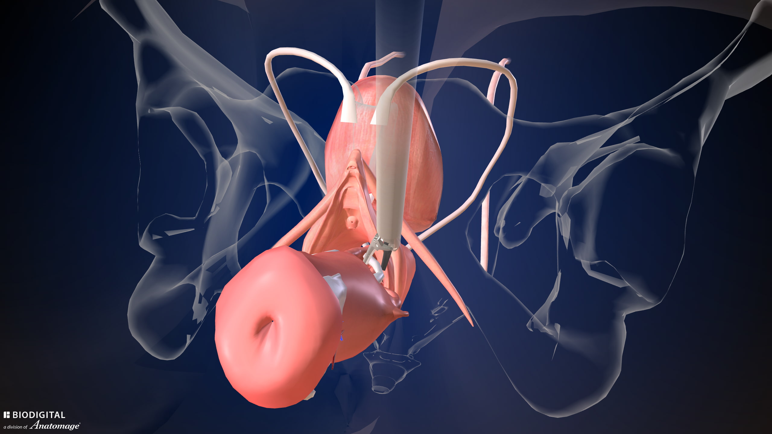 Total Vaginal Hysterectomy 3 Model