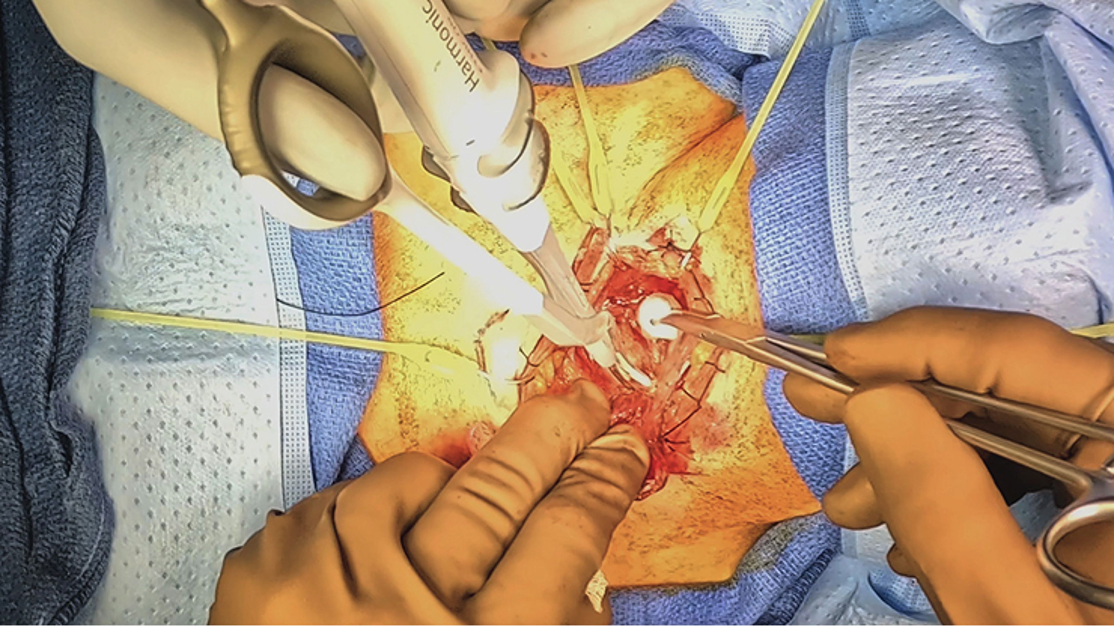 US_SRG_ENER_398979 - Right thyroidectomy with paratracheal dissection using HARMONIC FOCUS™+ Shears and SURGICEL™ FIBRILLAR™ Absorbable Hemostat with Alfred Simental, MD