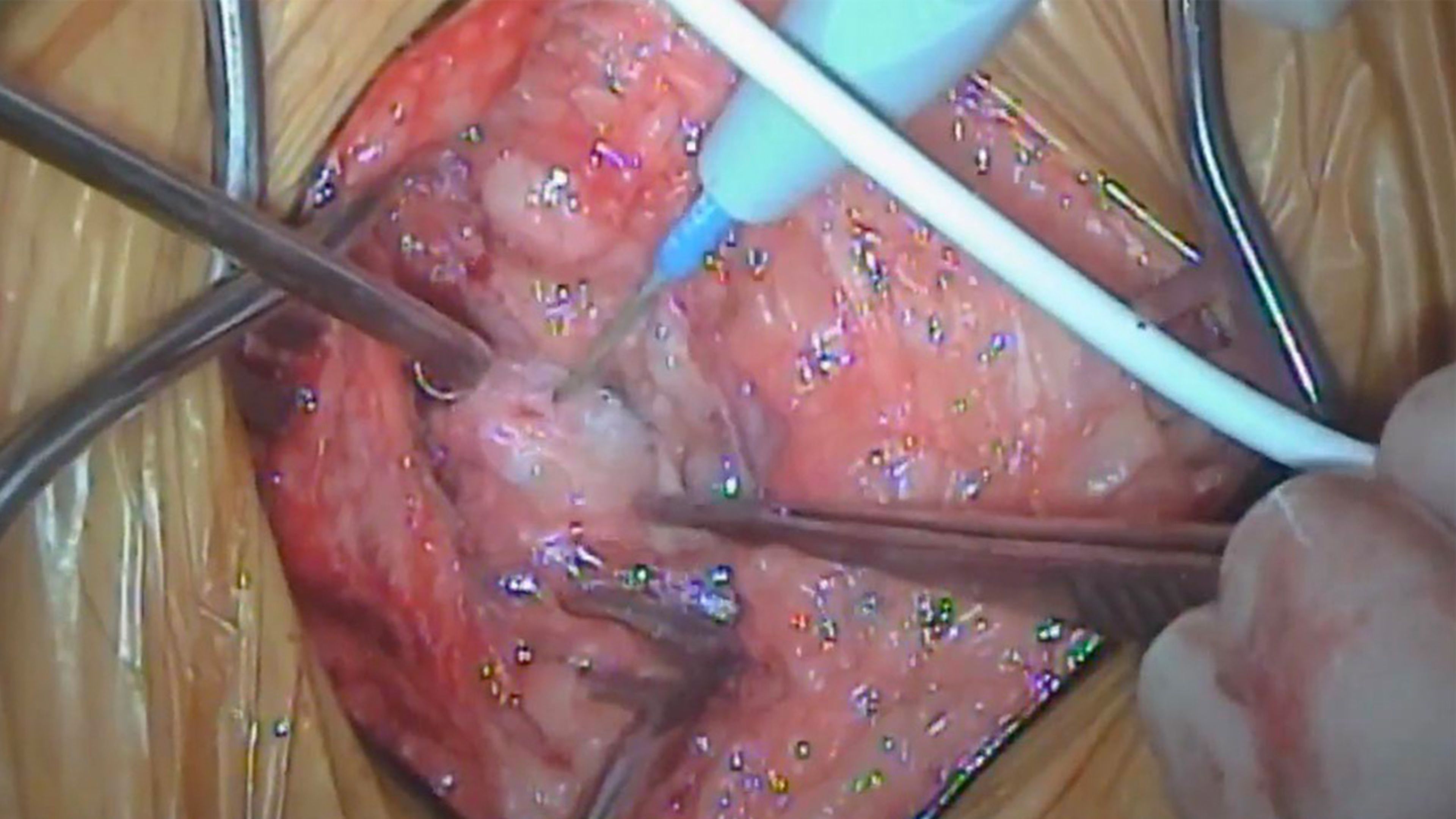 Femoral sheath incision