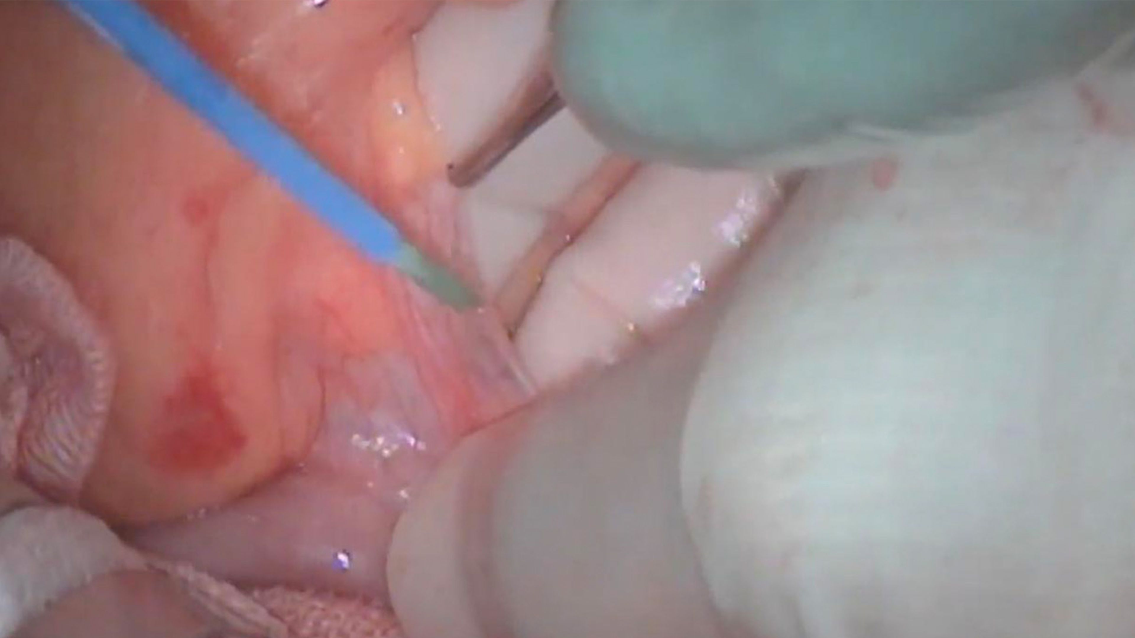Ligament of Treitz incision