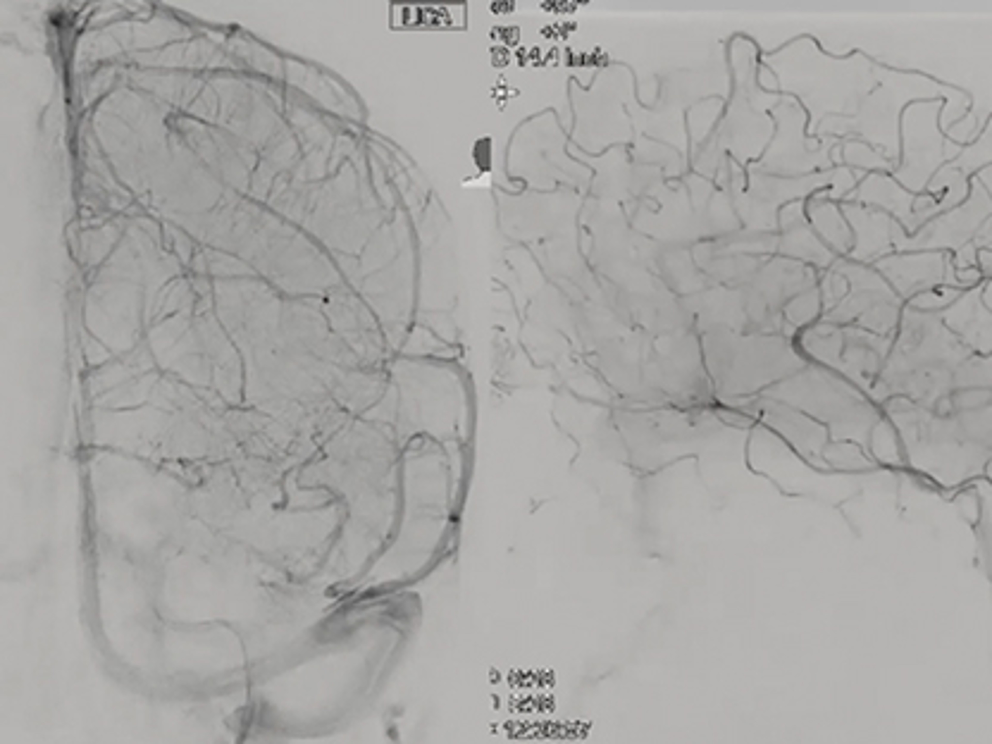 Illustration of angiography