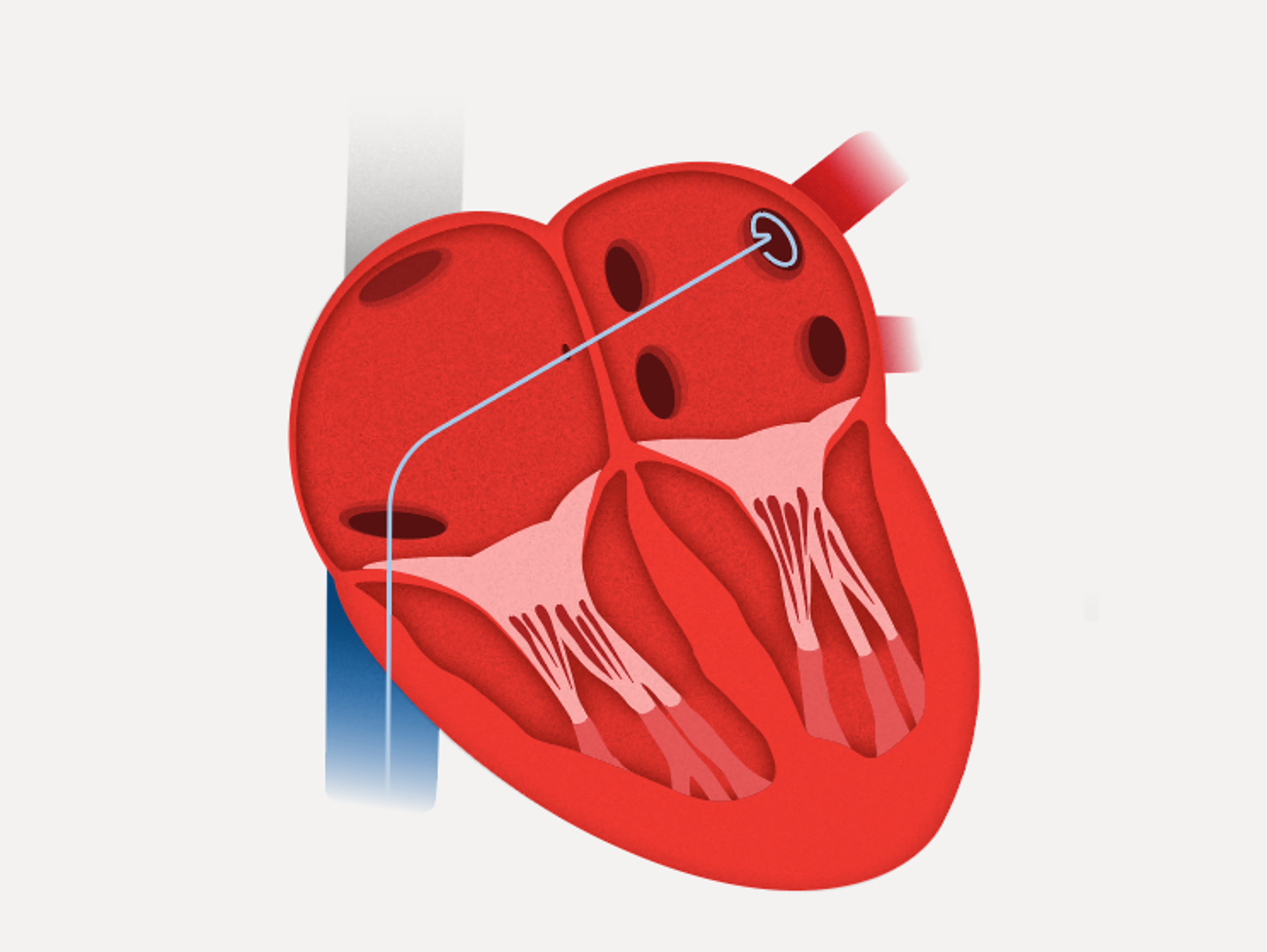 Illustration of heart with VARIPULSE™ Catheter