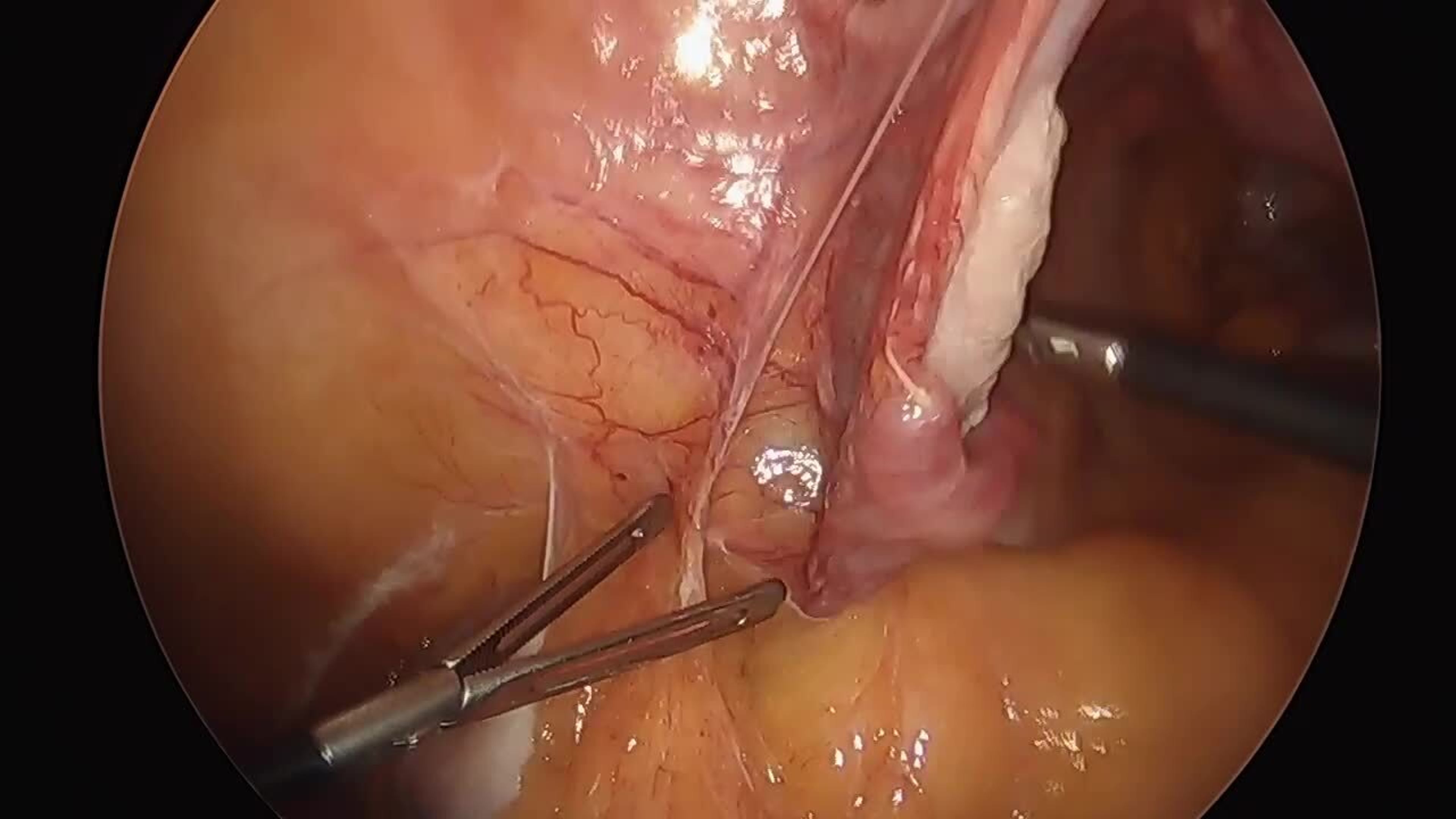 Total laparoscopic hysterectomy