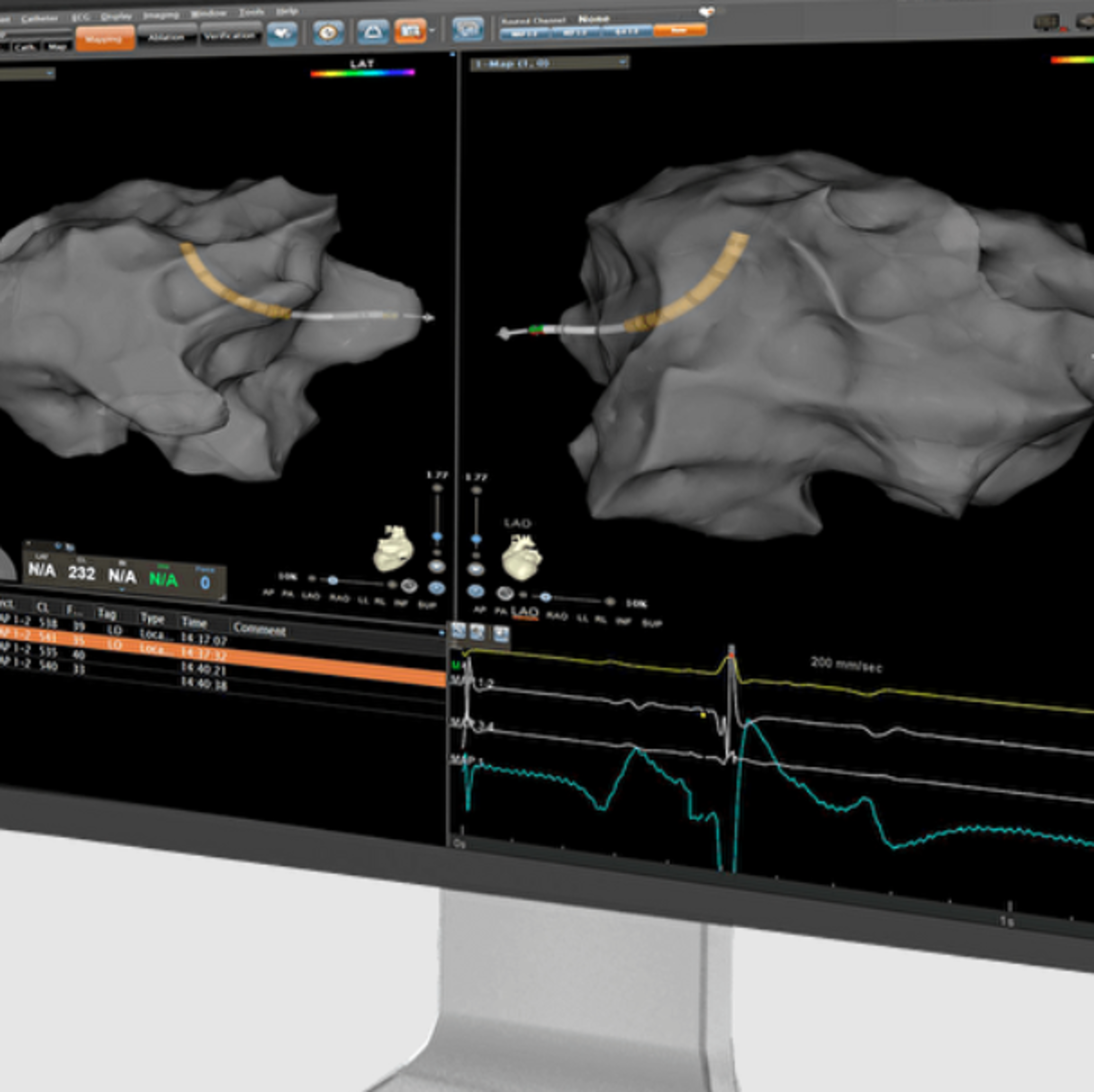 A close-up view of a CARTO™ 3 System monitor with the CARTO VIZIGO™ Bi-Directional Guiding Sheath visualized inside the anatomy.