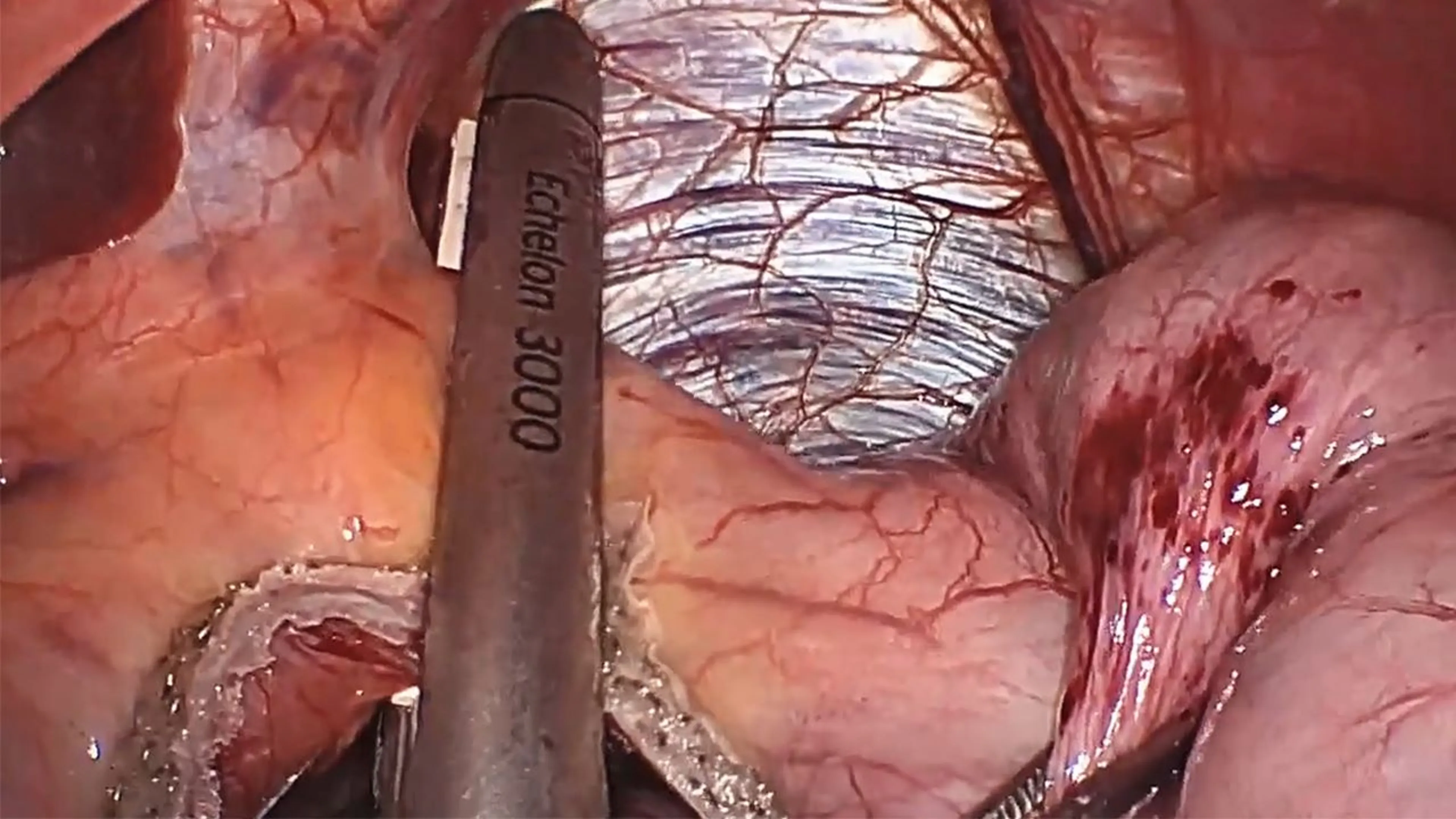 US_SRG_STAP_117752.1 - Sleeve gastrectomy using the ECHELON™ 3000 Stapler with ECHELON ENDOPATH™ Staple Line Reinforcement and HARMONIC™ 1100 Shears with Betsy Dovec, MD