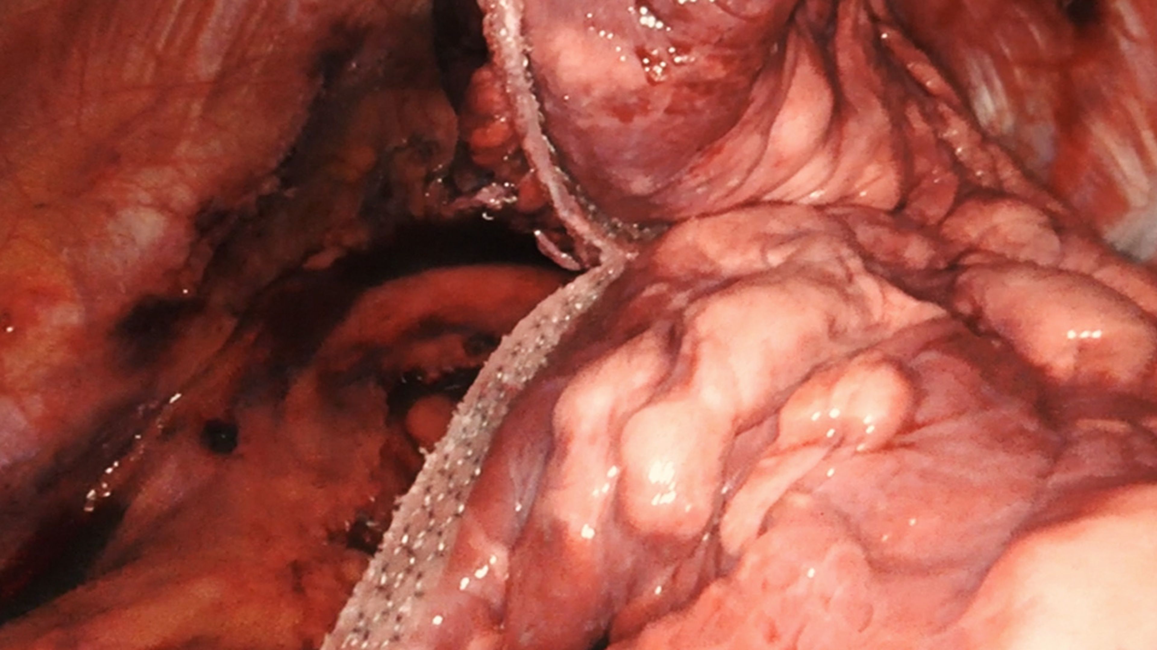US_ETH_STAP_390603	Reducing air leaks in robotic thoracic surgery with Emily Cassidy, MD