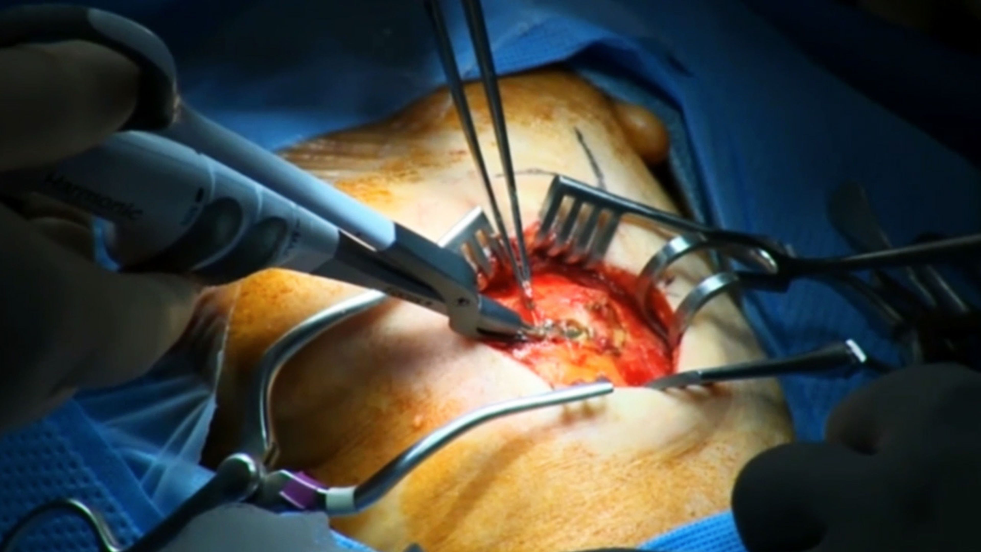 US_ETH_ENER_394802 - Excision of submandibular tumor using HARMONIC FOCUS™+ Shears with Phillip Pellitteri, DO