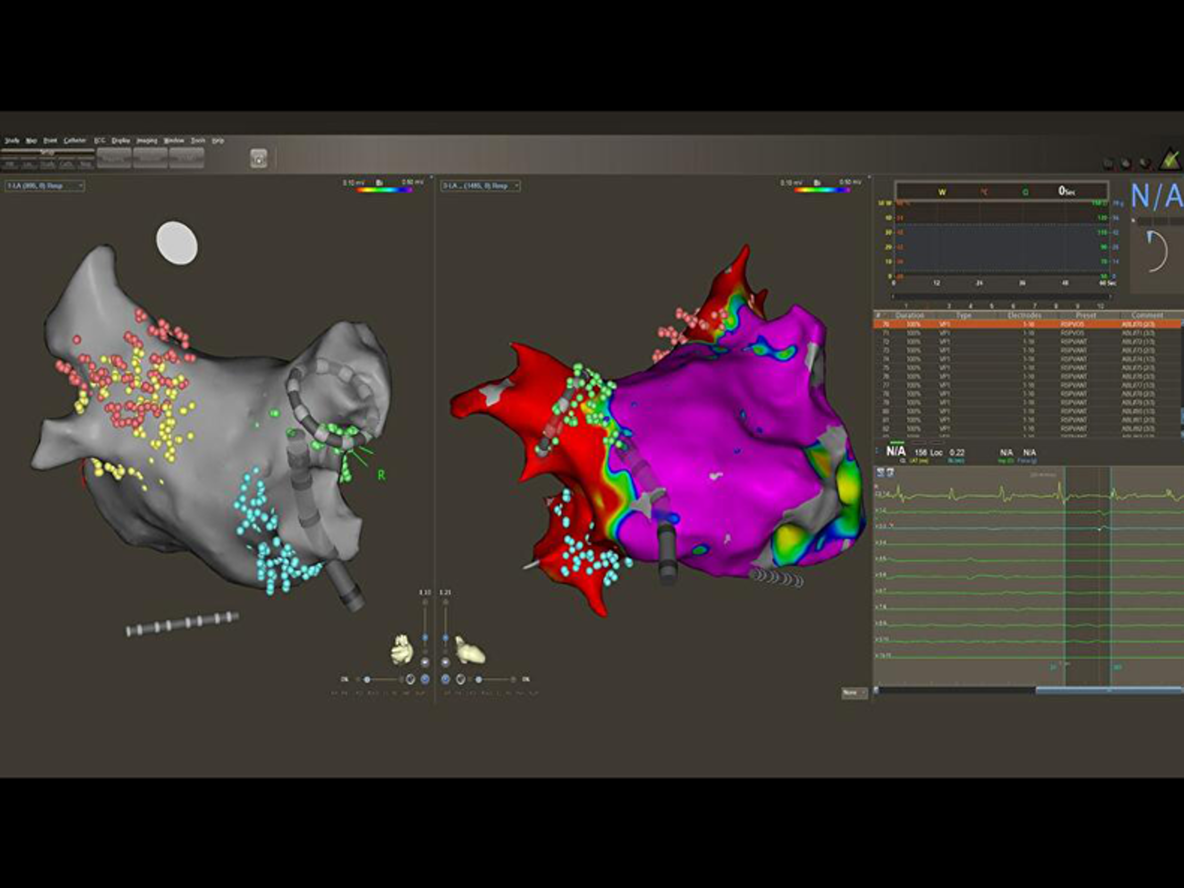 CARTO™ map showing VARIPULSE™ Catheter.