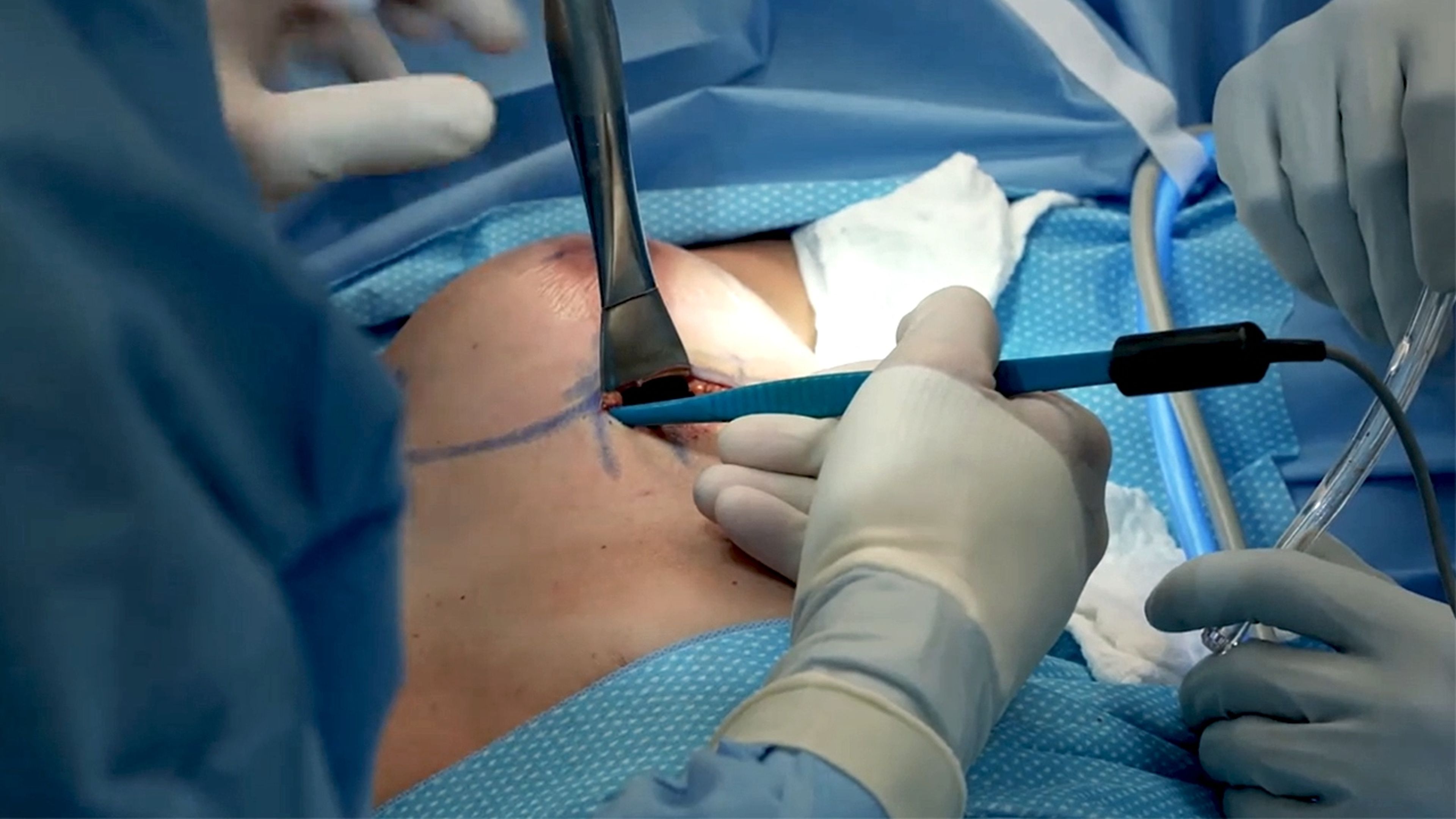US_MNT_BRST_166174 - Look-Live Surgery™ with Dr. William P. Adams Jr. and M. Bradley Calobrace, M.D. | Primary breast augmentation with MENTOR™ MemoryGel BOOST™ Breast Implants