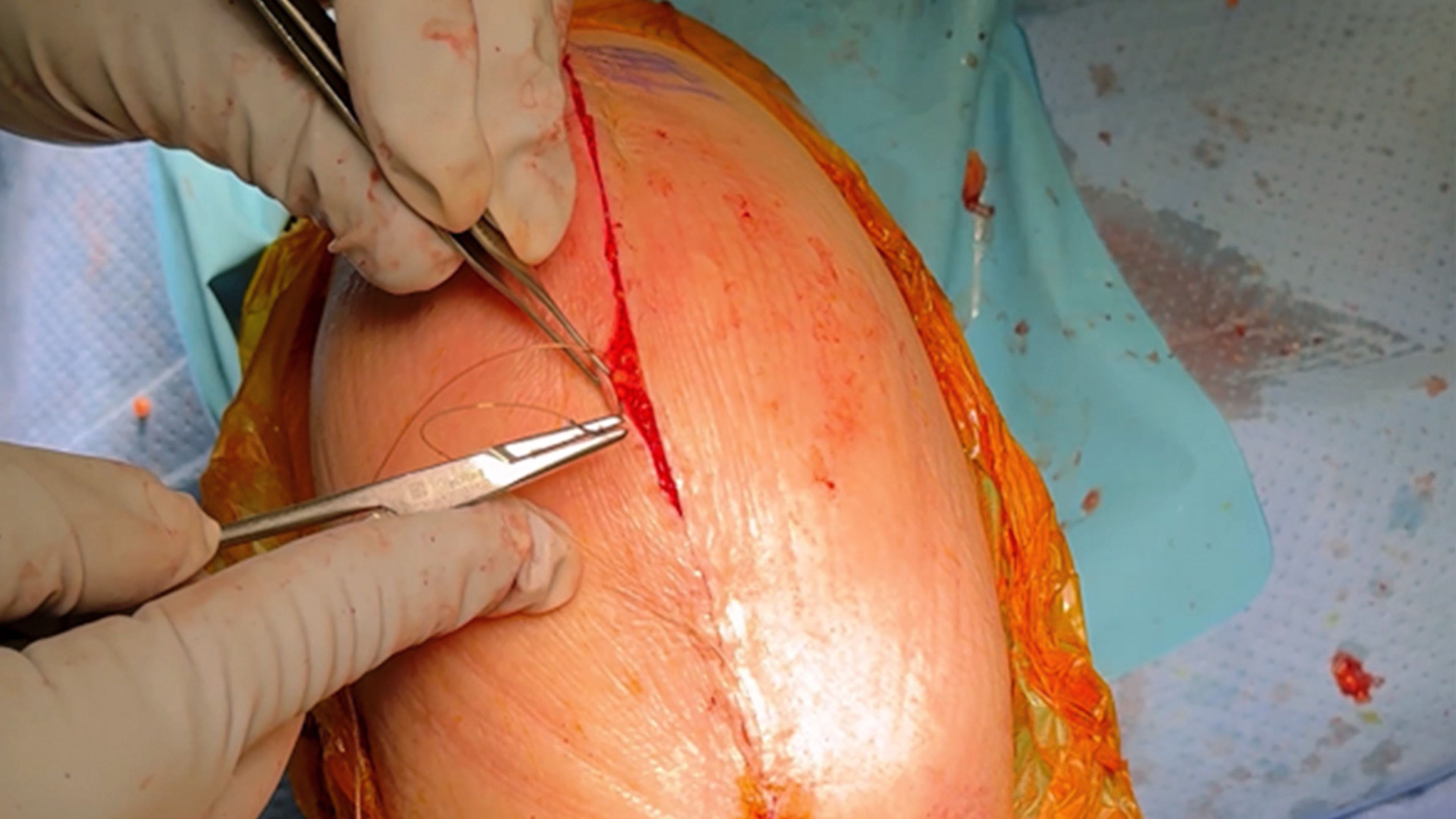 US_SRG_WOUN_417527 - Marginal gains in joint restoration using STRATAFIX™ Antibacterial Barbed Sutures and DERMABOND™ PRINEO™ Skin Closure System with RB Jones, MD