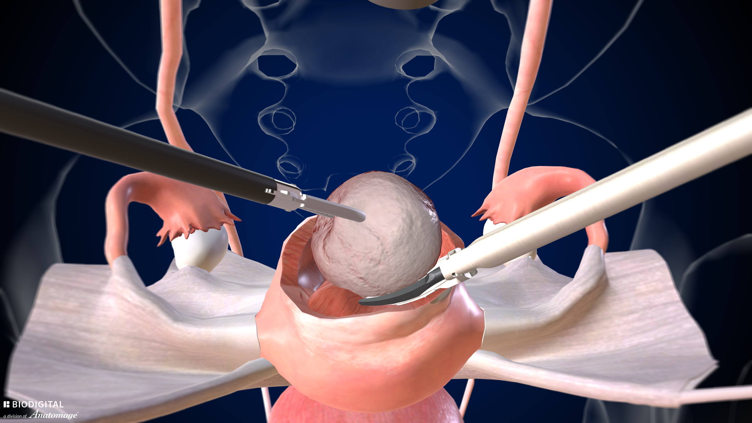 Laparoscopic Myomectomy