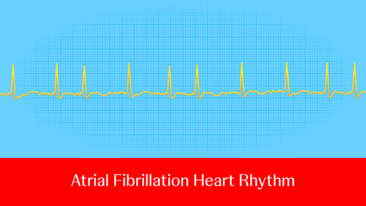 Ask an electrophysiologist: What roles do PFA and RFA play in the ...