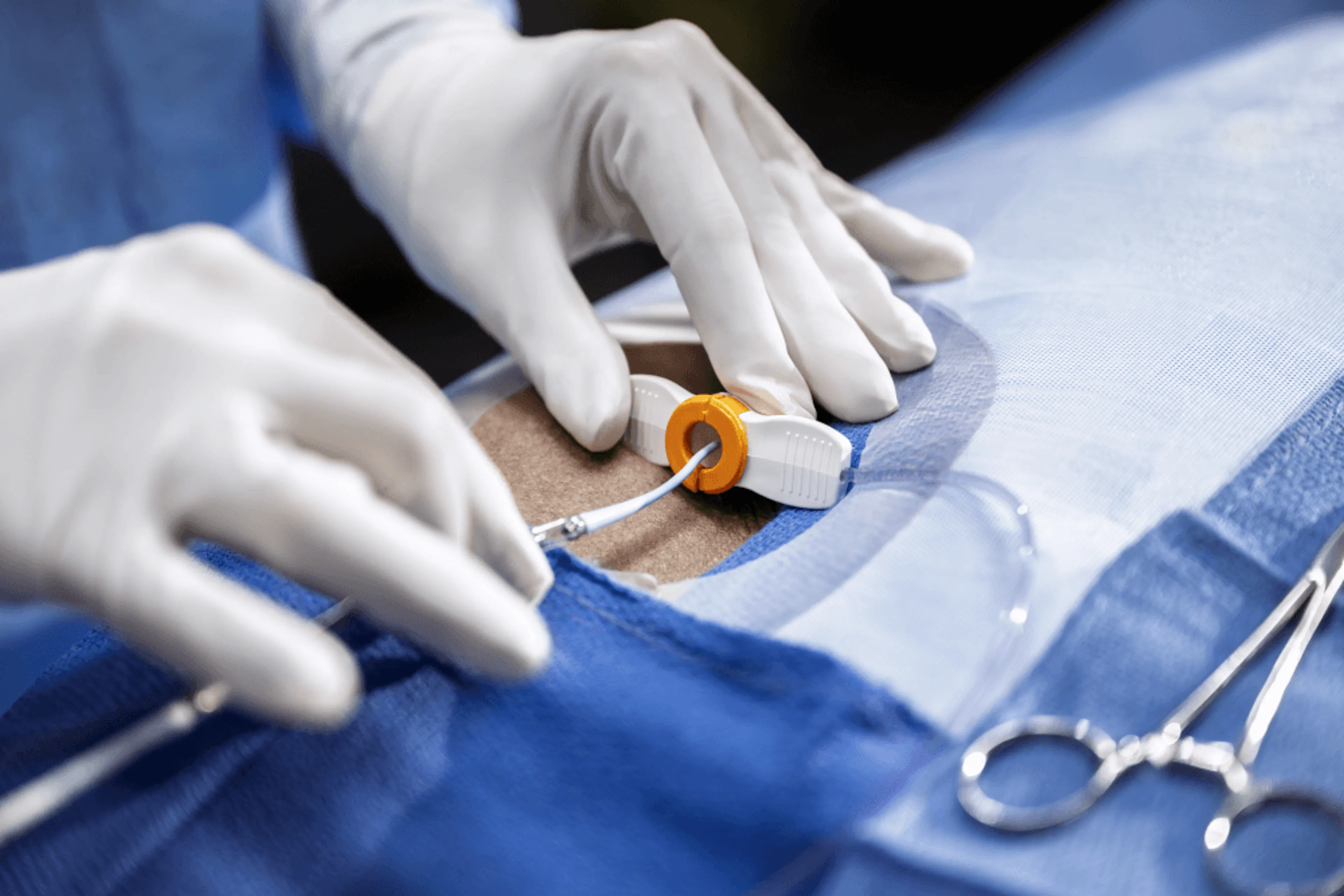 Close-up view of an endovascular procedure showing the sheath inserted in the groin and the inlet portion of the Impella catheter being positioned by a clinician wearing sterile gloves.