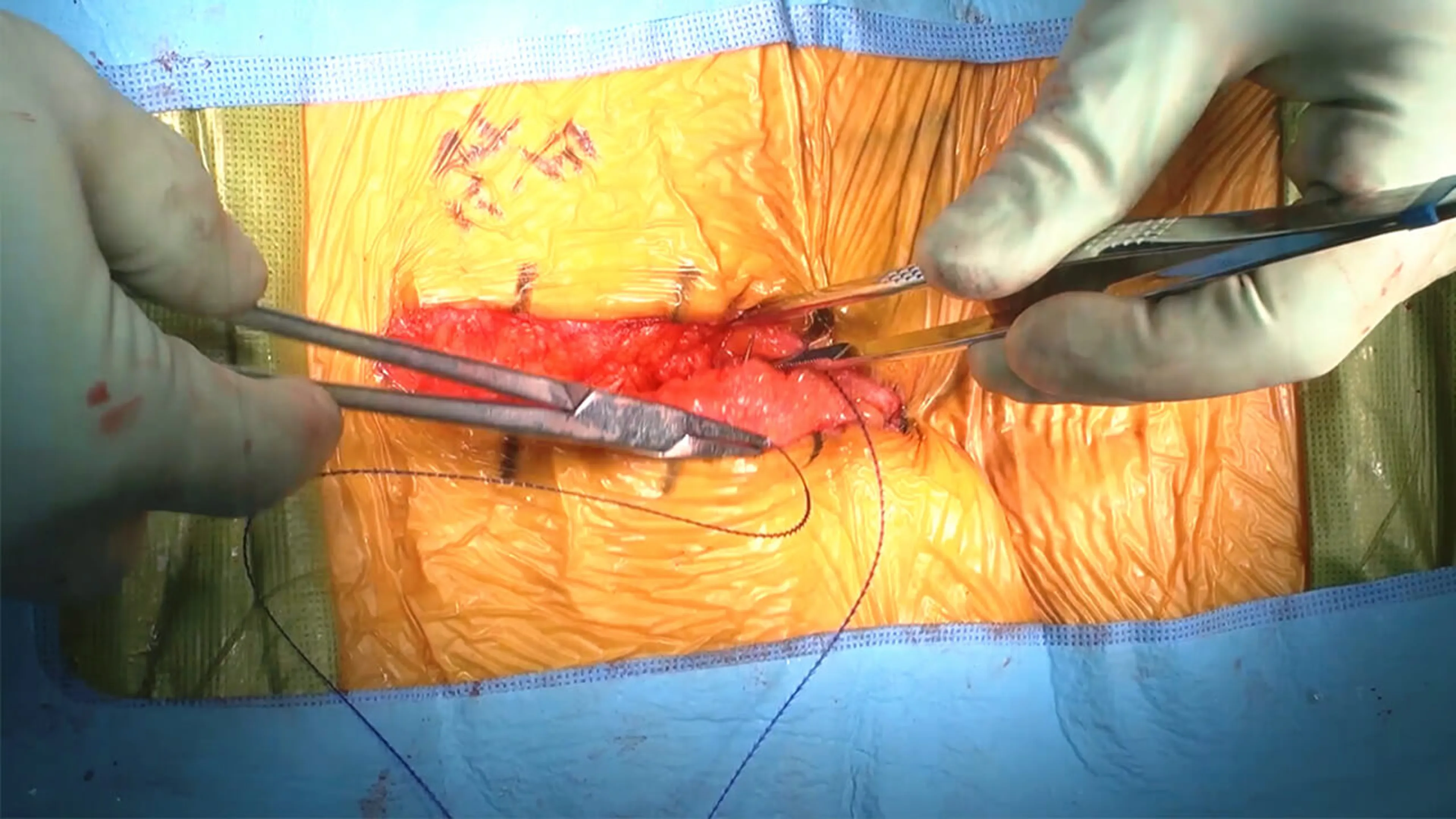 US_SRG_WOUN_111782.1 Anterior approach spine closure using STRATAFIX™ Knotless Tissue Control Device and DERMABOND™ PRINEO™ Skin Closure System with Christopher Cain, MD