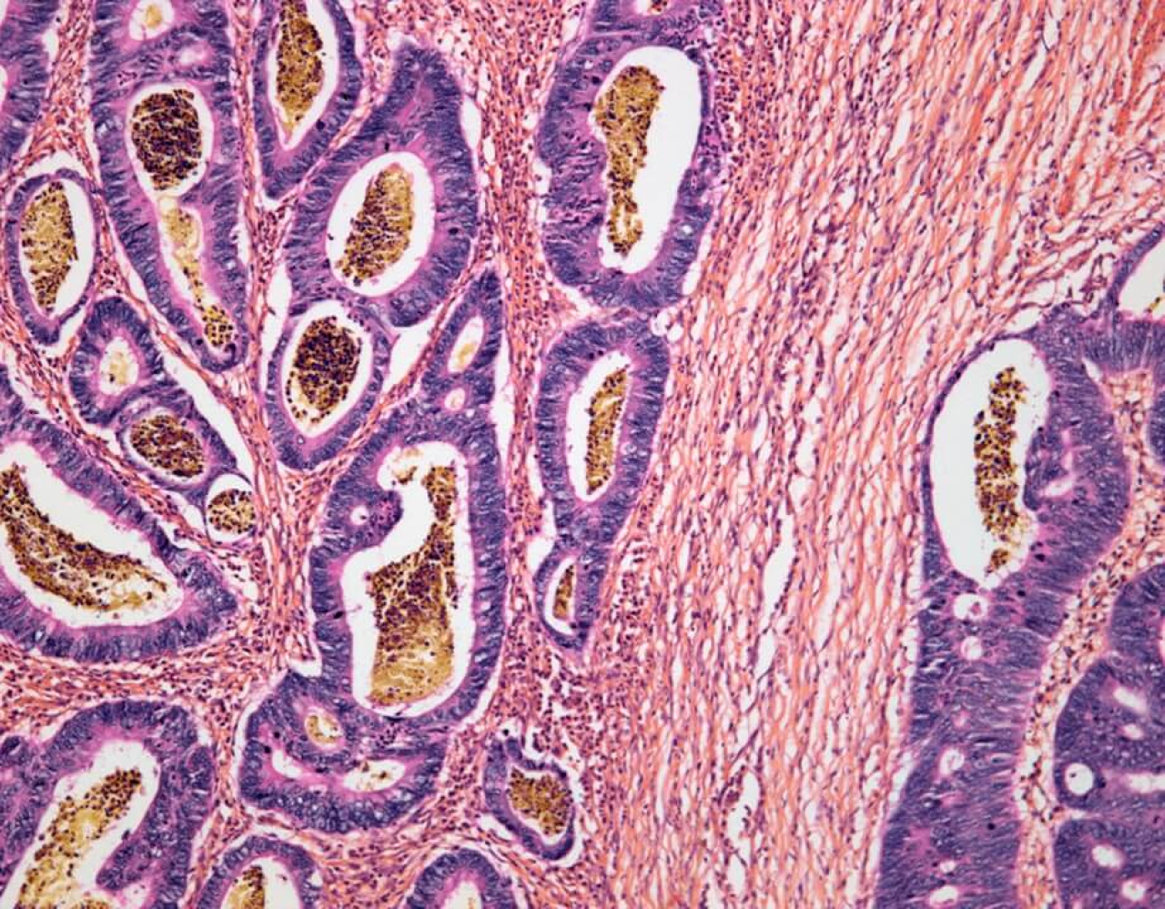 A close-up images of colorectal cancer cells
