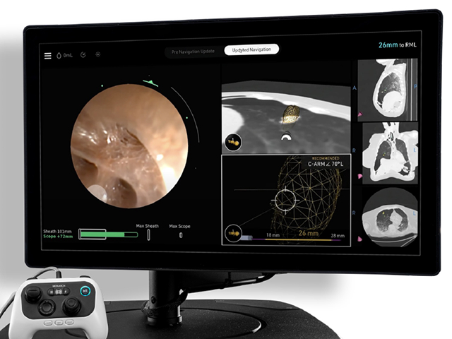 MONARCH Platform | Robotic-assisted bronchoscopy (RAB) | J&J