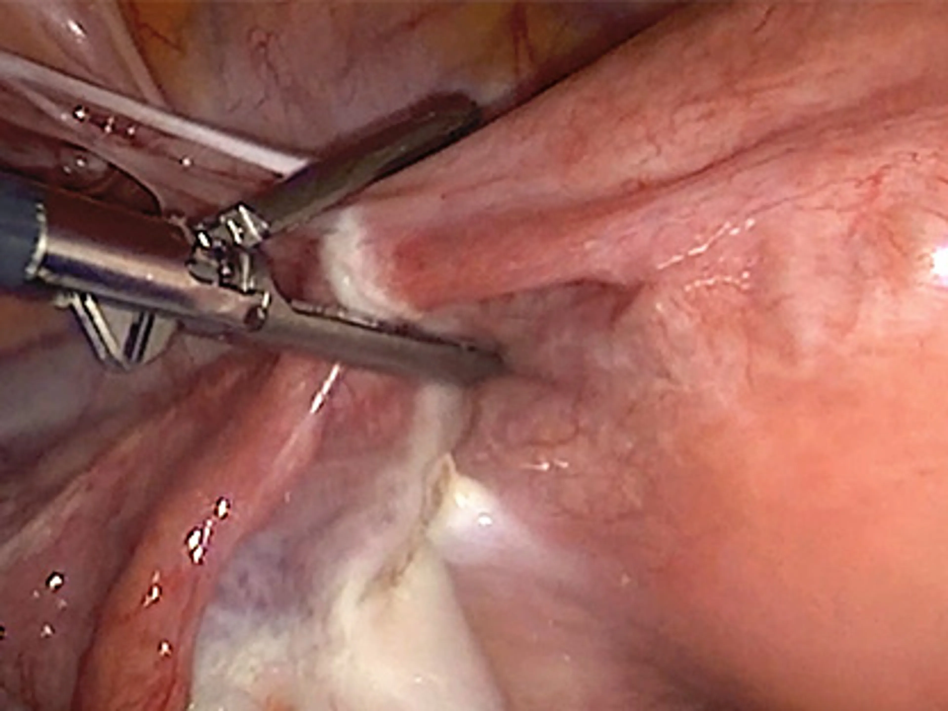 Optimizing Energy Devices in Gynecological Surgery with Kurian Thott, MD