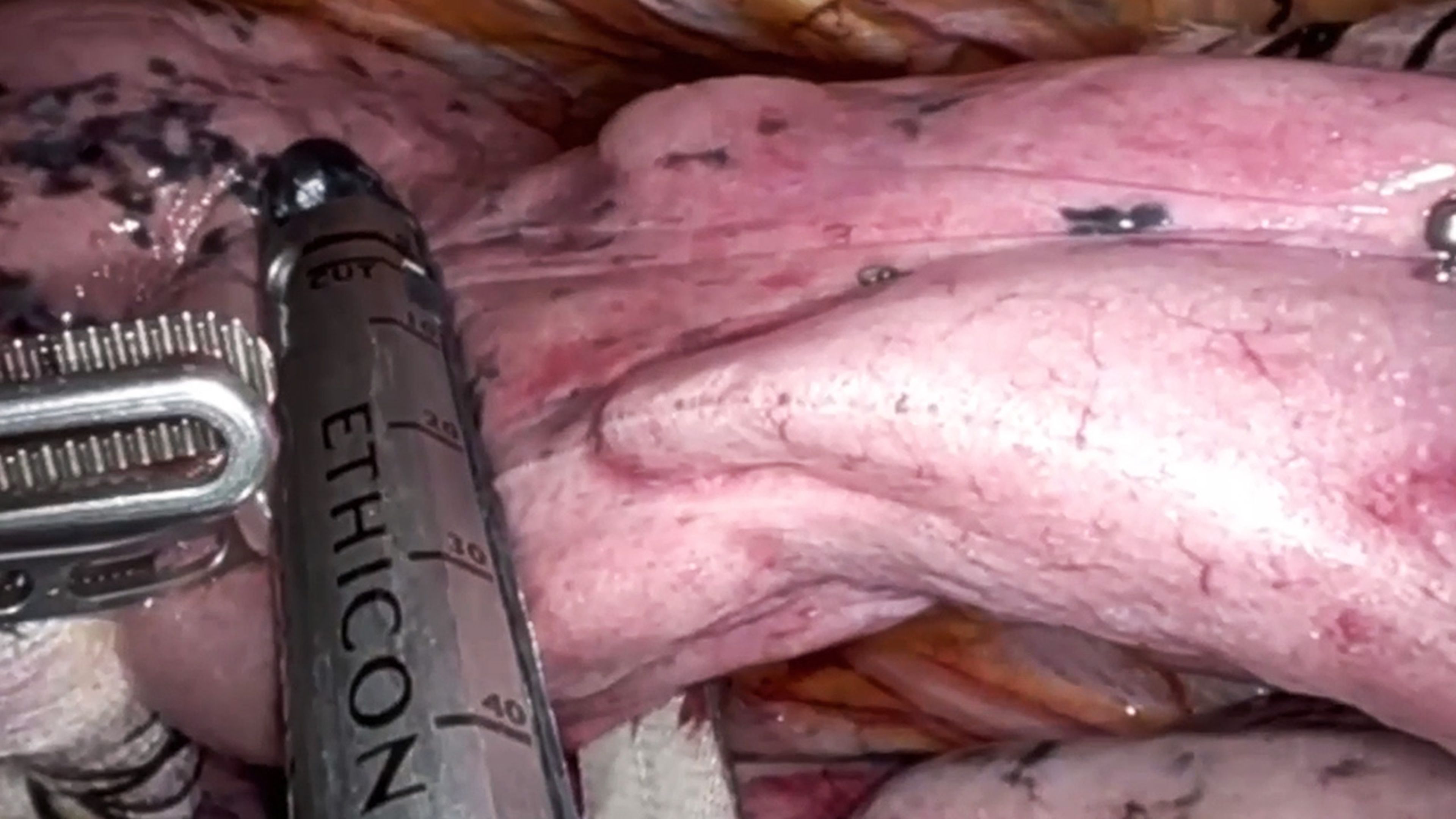 US_ETH_STAP_344547 - Robotic segmentectomy using the ECHELON™ 3000 Stapler and ECHELON™+ Stapler with Mathew Ninan, MD