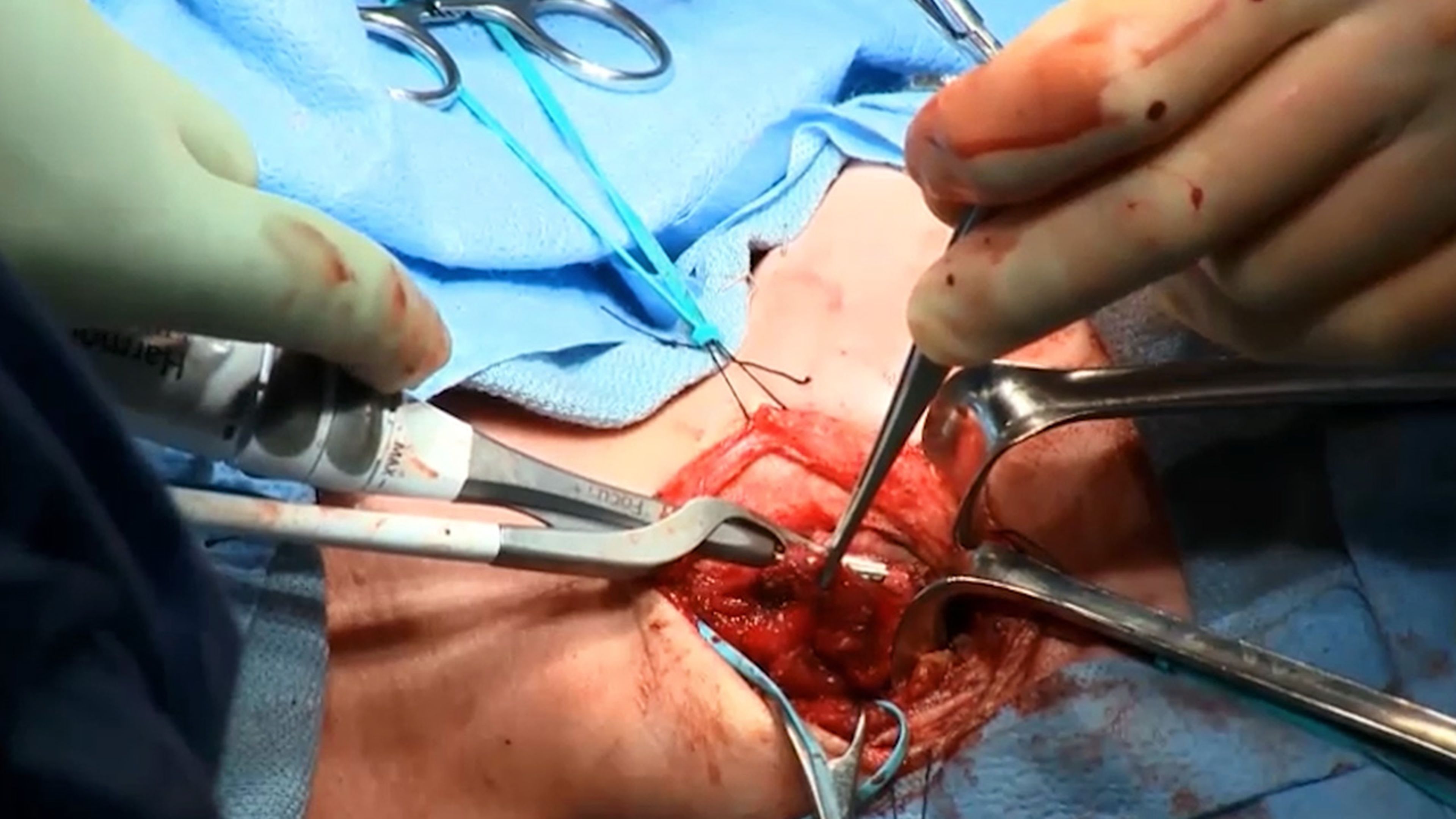 US_ETH_ENER_394813 - Excision of neck mass using HARMONIC FOCUS™+ Shears with David Goldenberg, MD