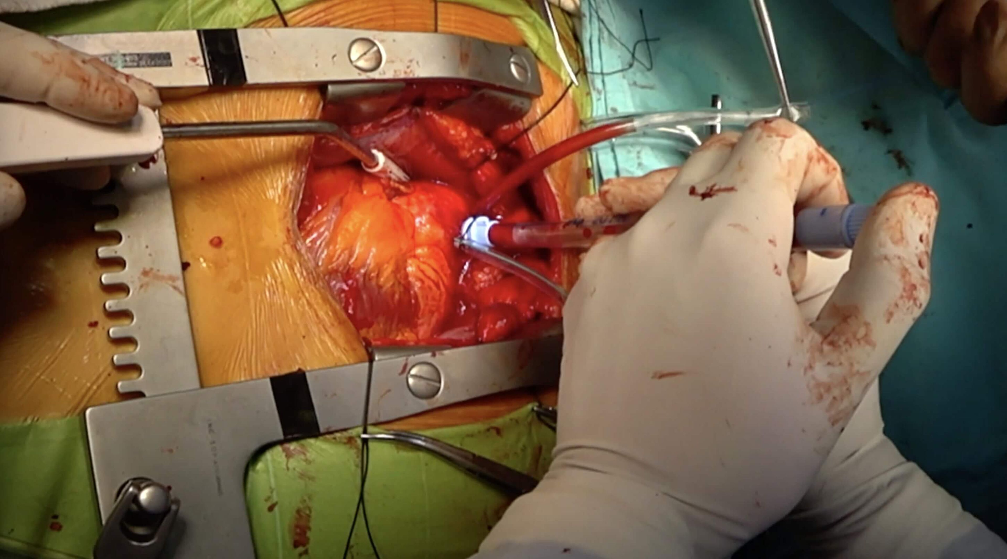 Aortic Cannula