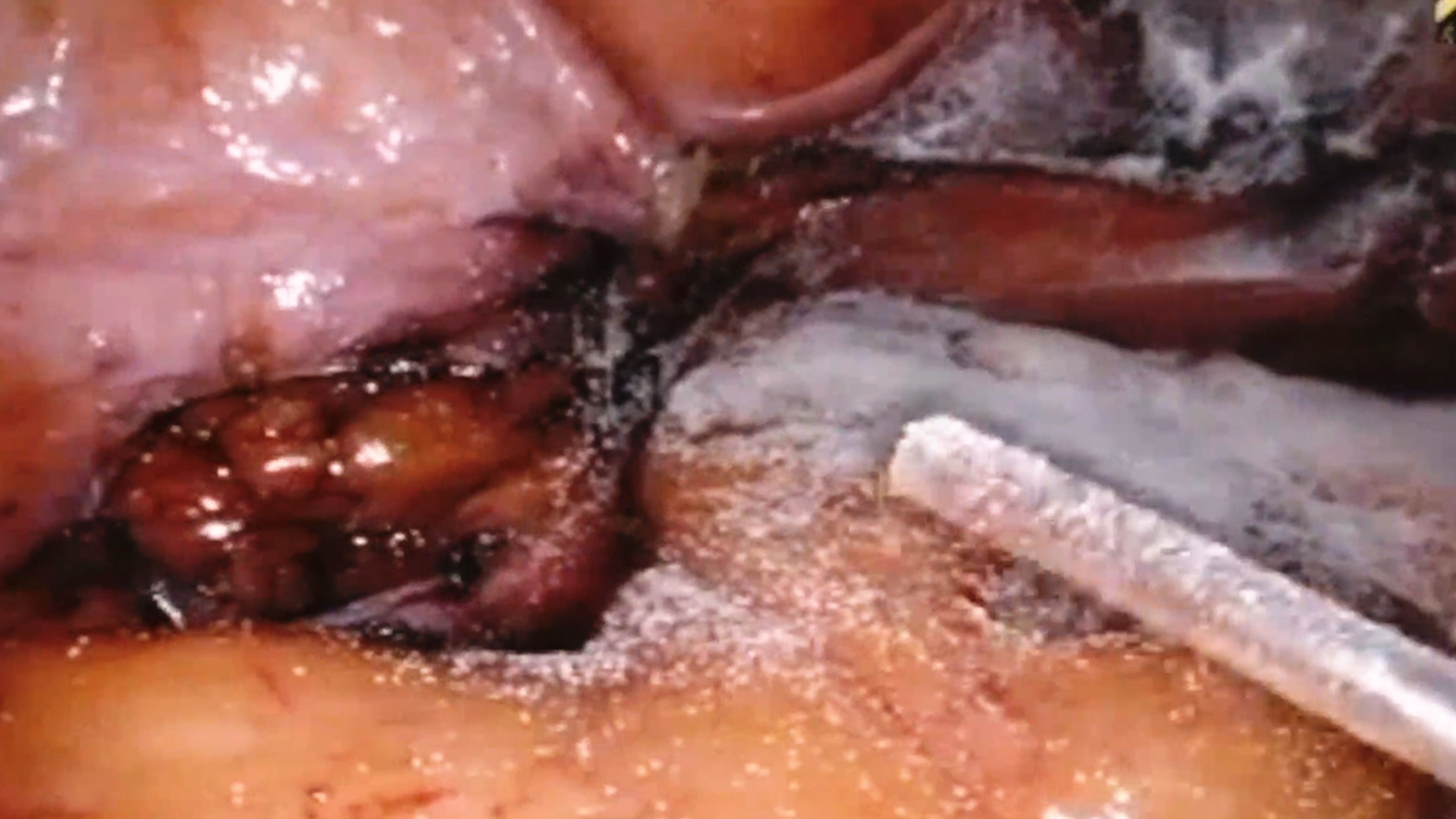 US_ETH_ENER_222560 - Robotic hysterectomy using the ENSEAL™ X1 Curved Jaw Tissue Sealer and SURGICEL™ Powder with Jonathan Black, MD