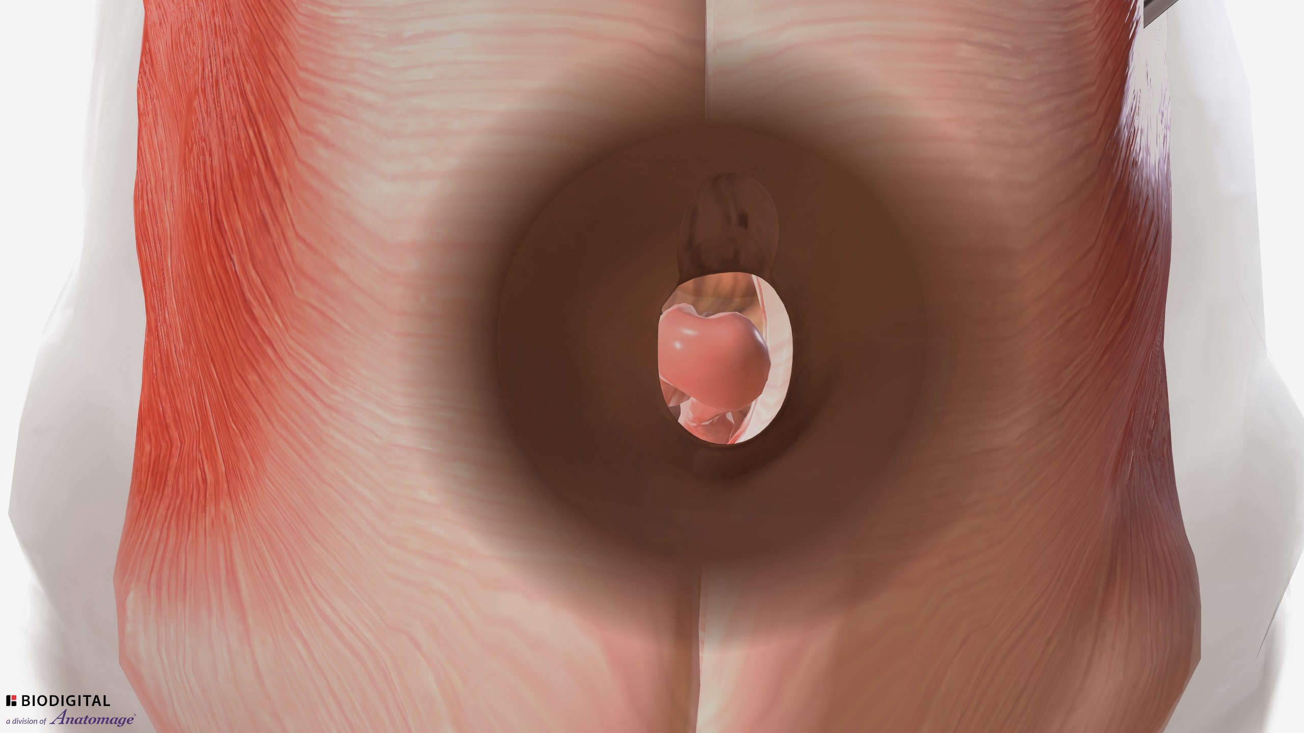 Ventral hernia repair - small umbilical hernia without mesh