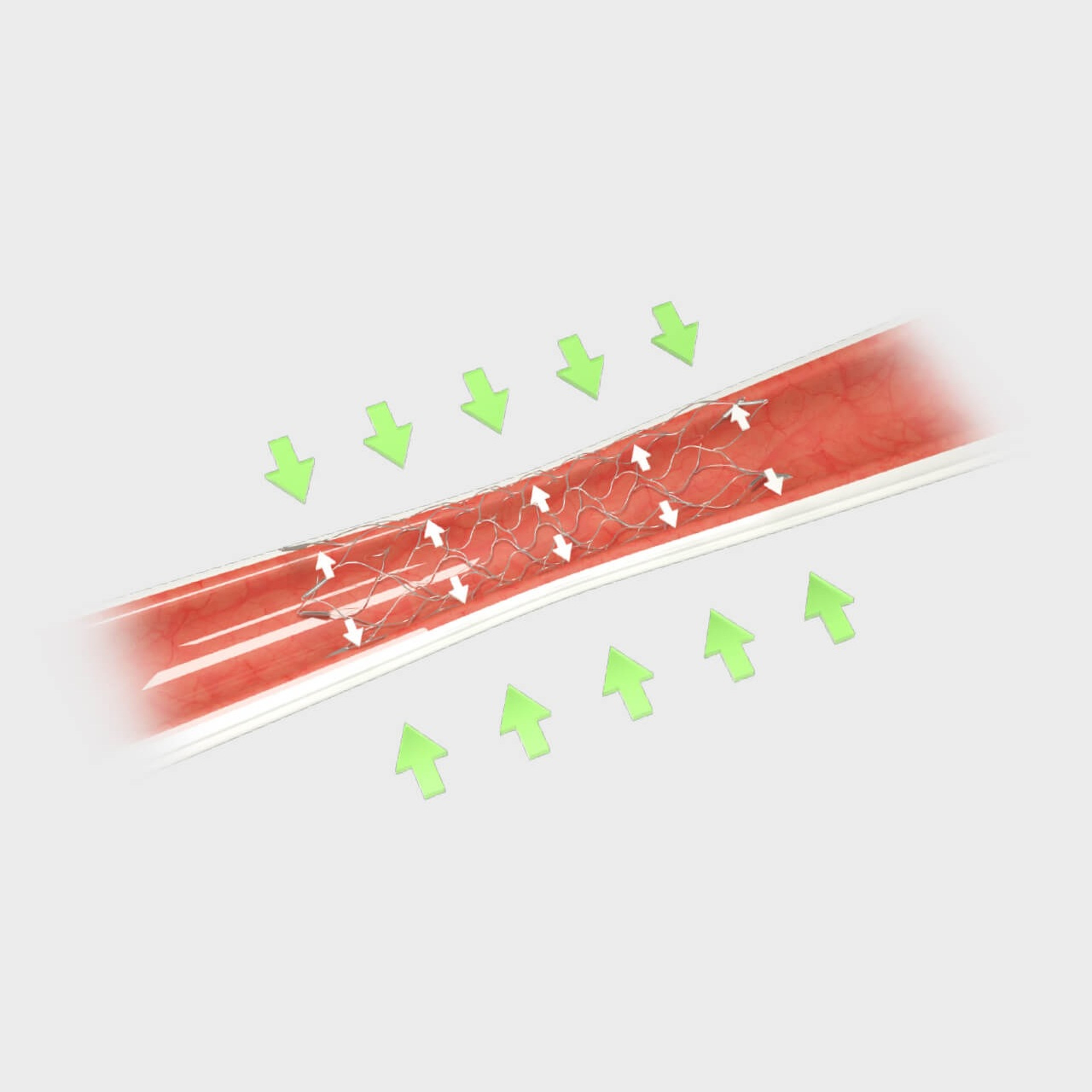 ENTERPRISE™2 Vascular Reconstruction Device