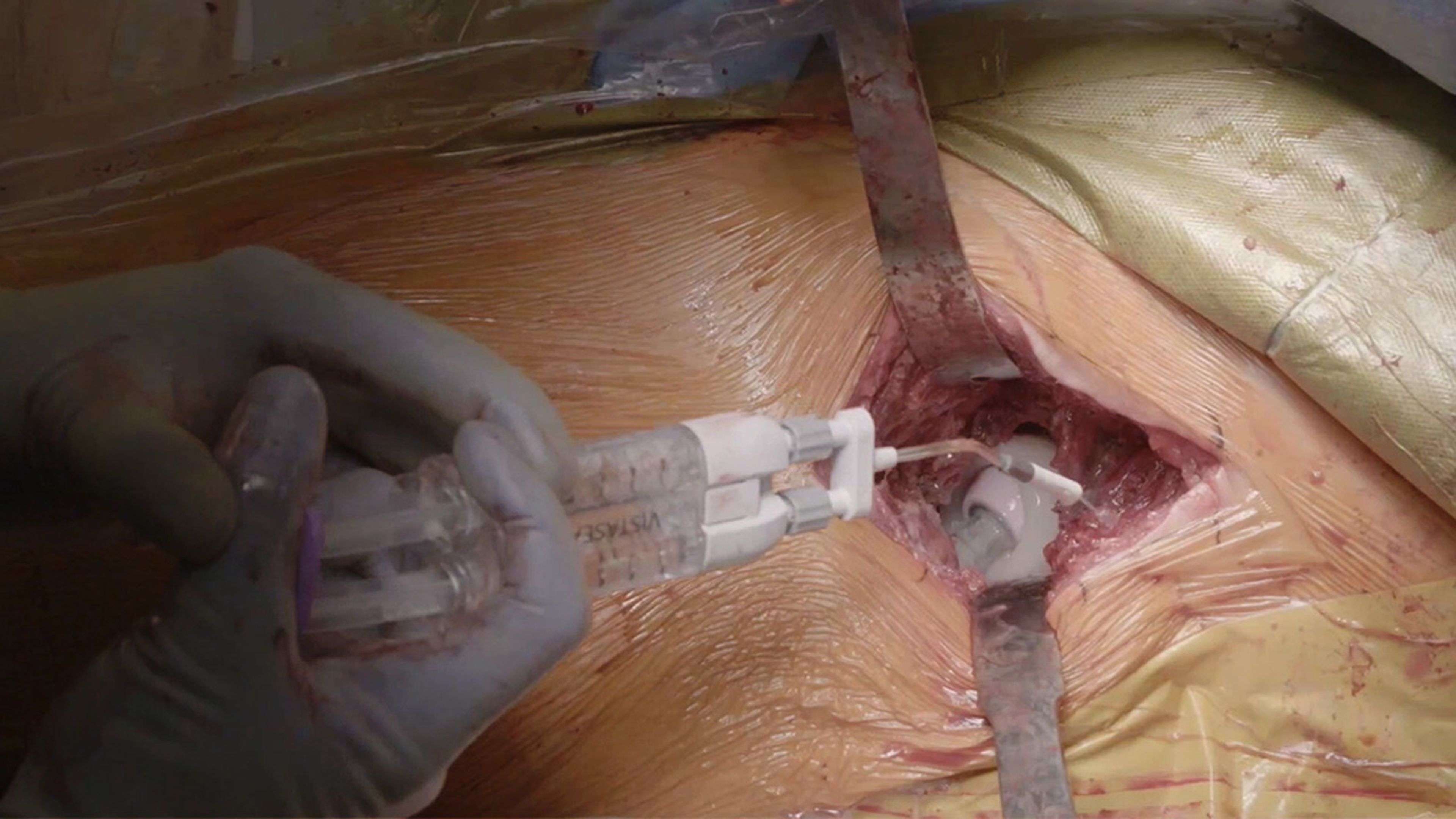 US_ETH_BIOS_387324 - Total hip arthroplasty using VISTASEAL™ Fibrin Sealant with Michael Muncy, DO