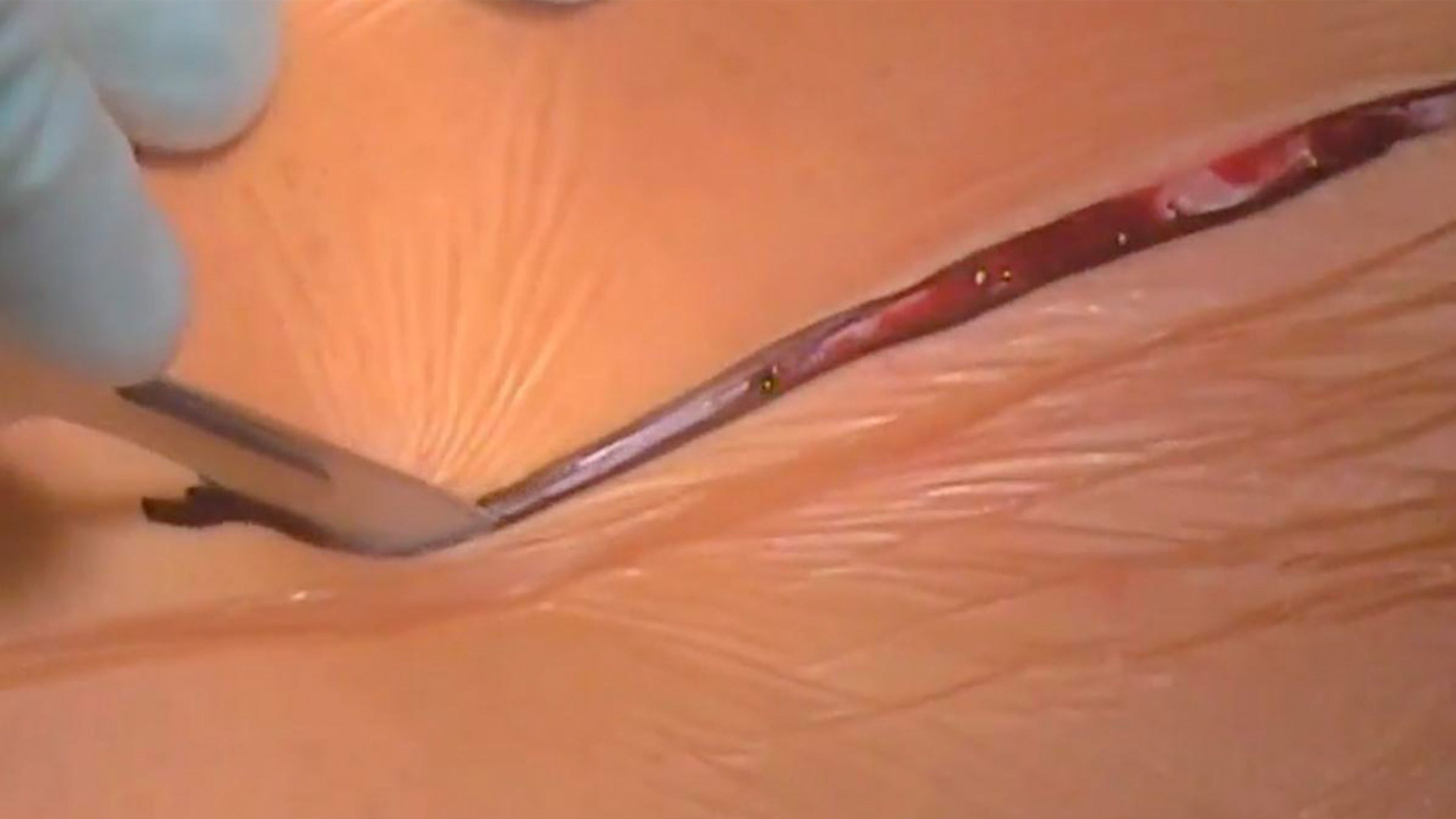 Midline laparotomy