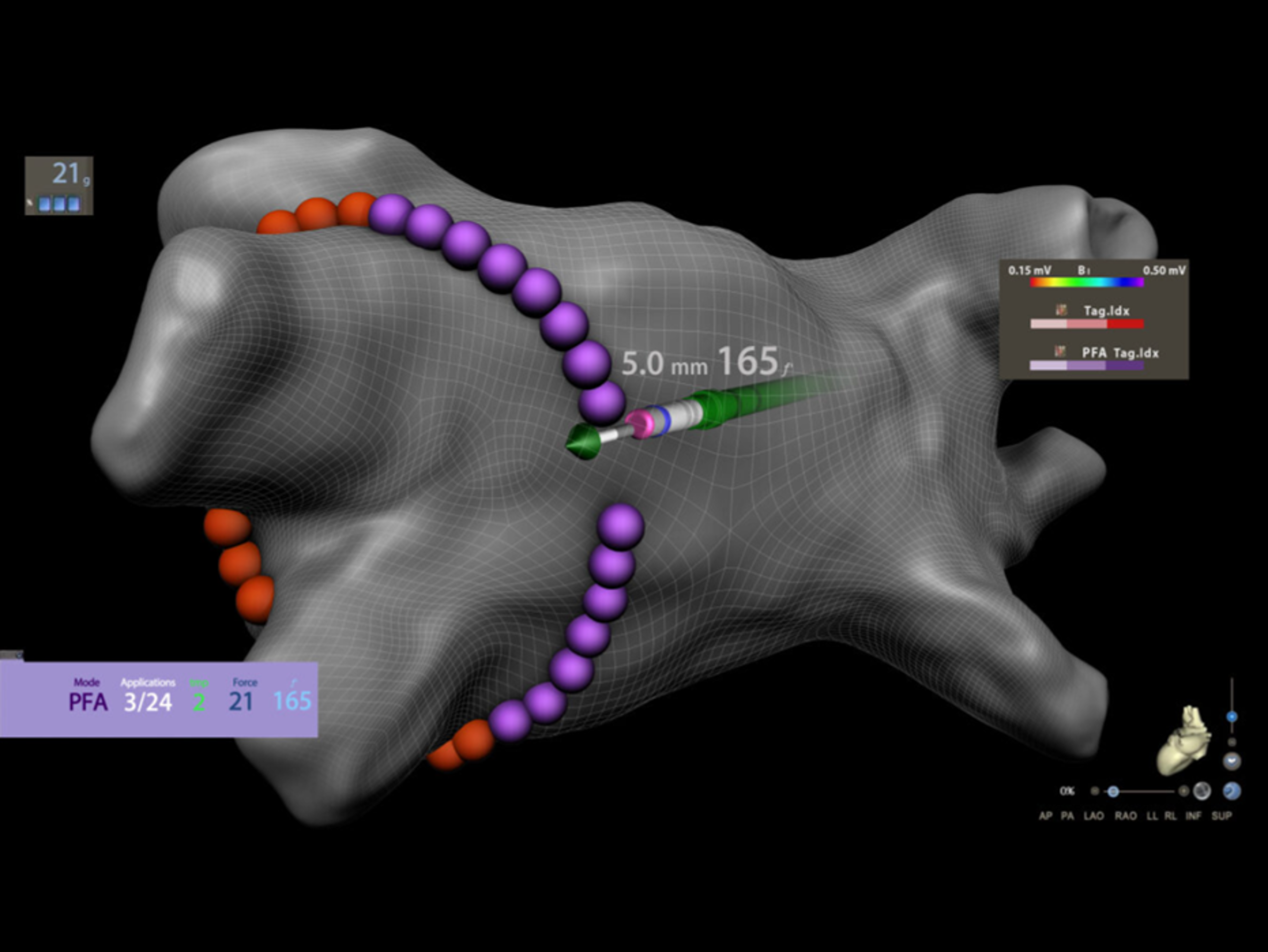 CARTO™ anatomical screen showing Dual Energy THERMOCOOL SMARTTOUCH™ SF Catheter