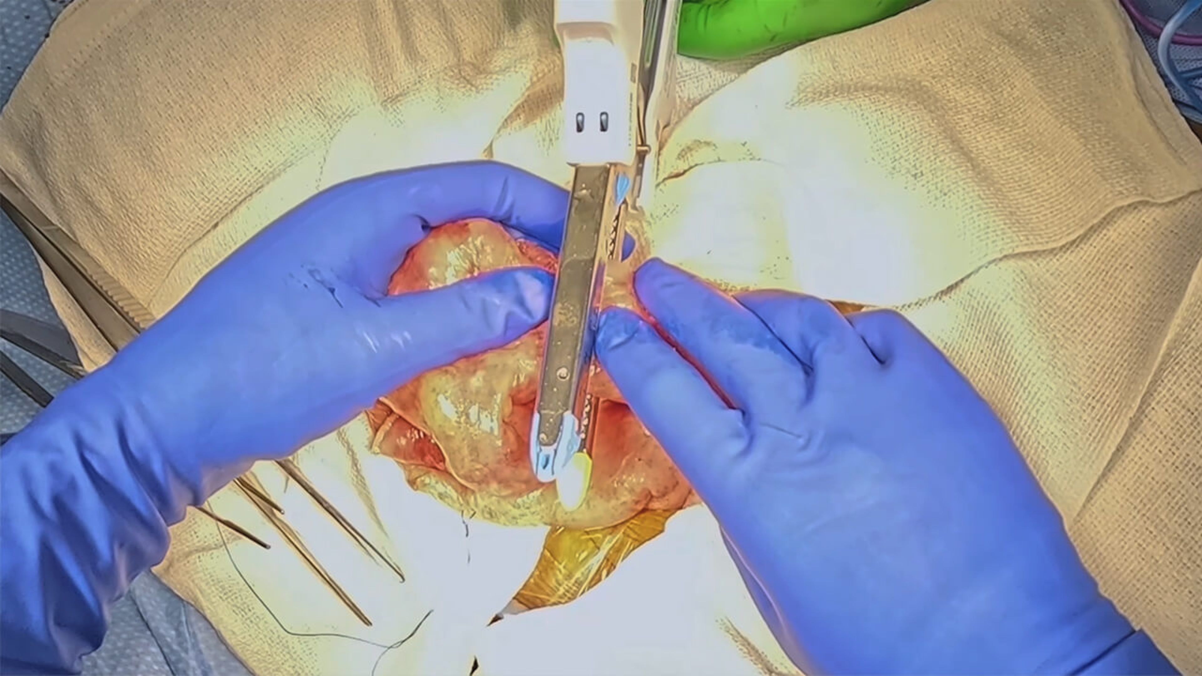 US_SRG_STAP_399208 - Ileocolic resection using the ECHELON™ Linear Cutter with Katerina Wells, MD