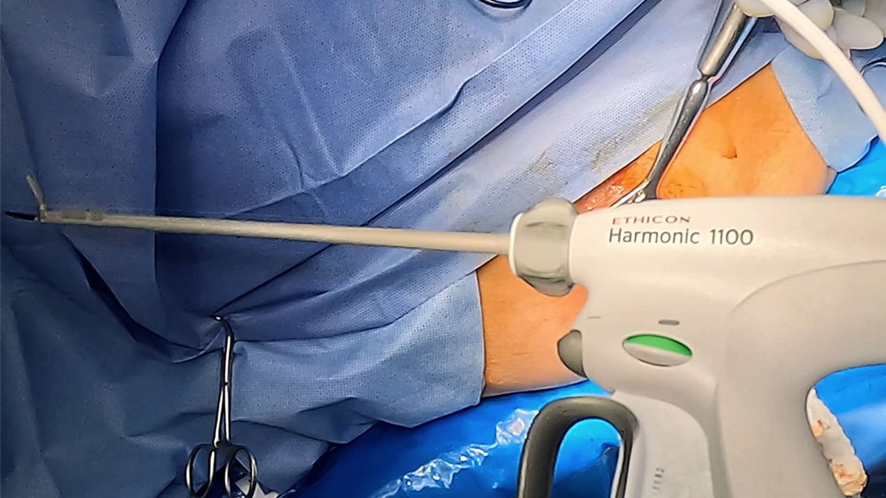Colon & rectal | J&J MedTech US