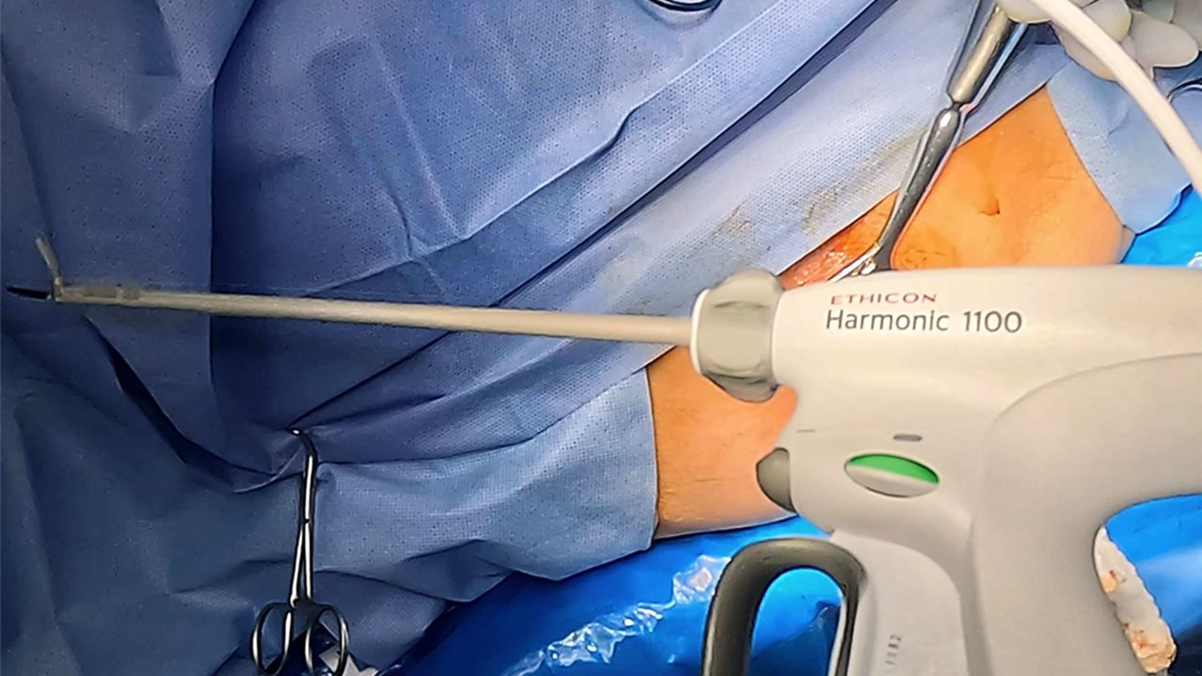 US_SRG_ENER_399051 - Internal and external hemorrhoidectomy using HARMONIC™ 1100 Shears with Ali Mahmood, MD