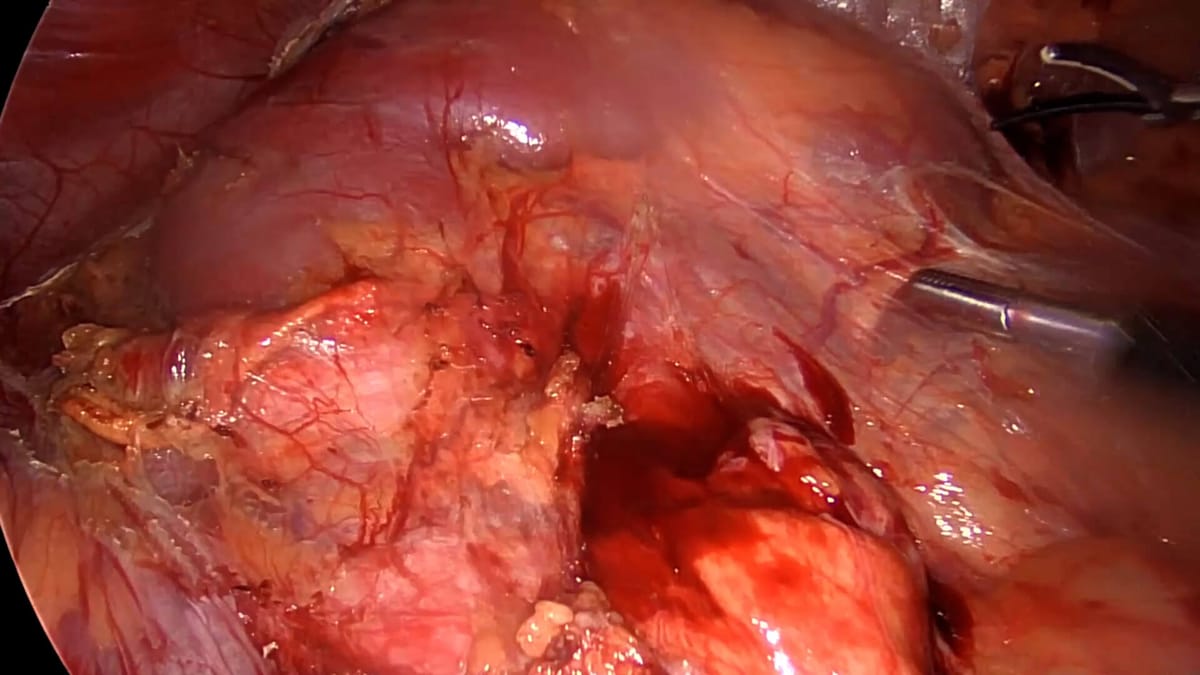 Laparoscopic donor nephrectomy | J&J MedTech US